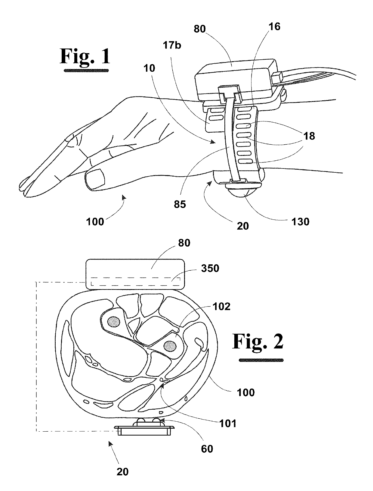 Improved wearable tonometer