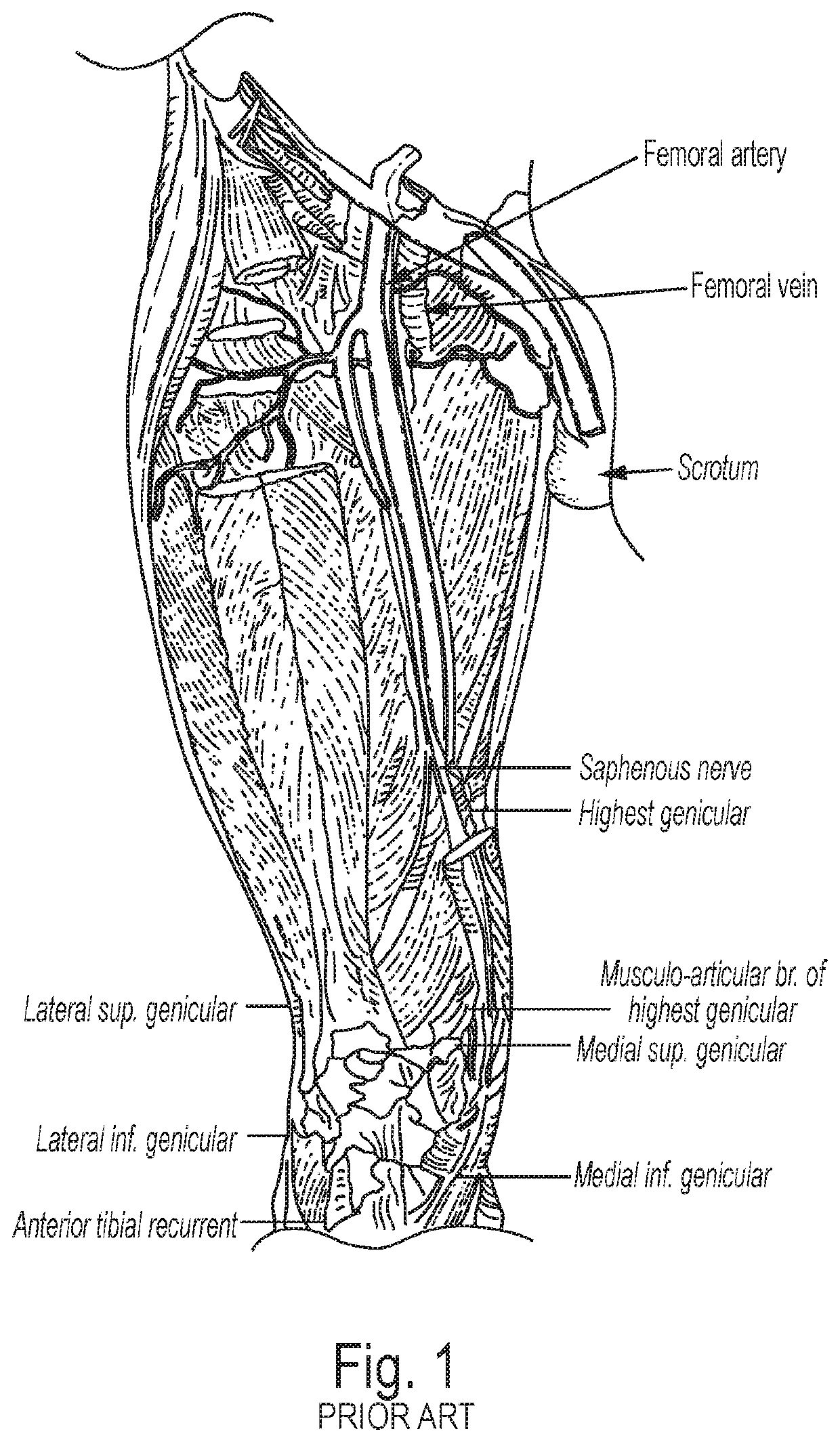 Device and method for automated emergency arterial sheath placement