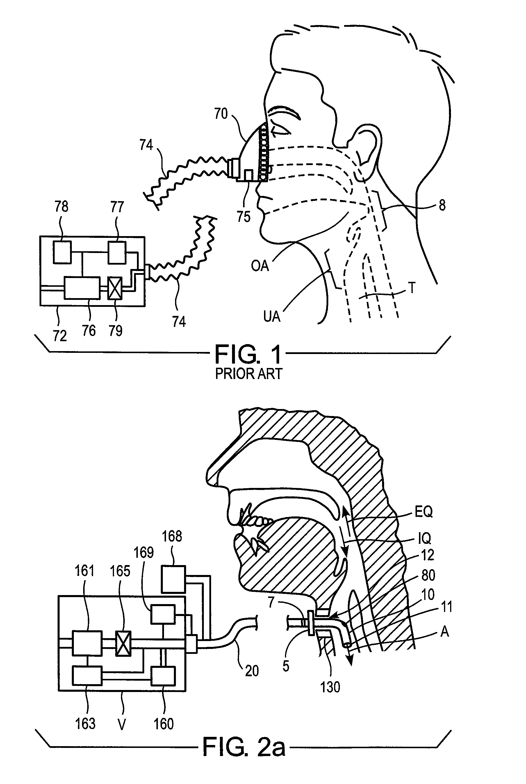 Methods and devices for treating sleep apnea