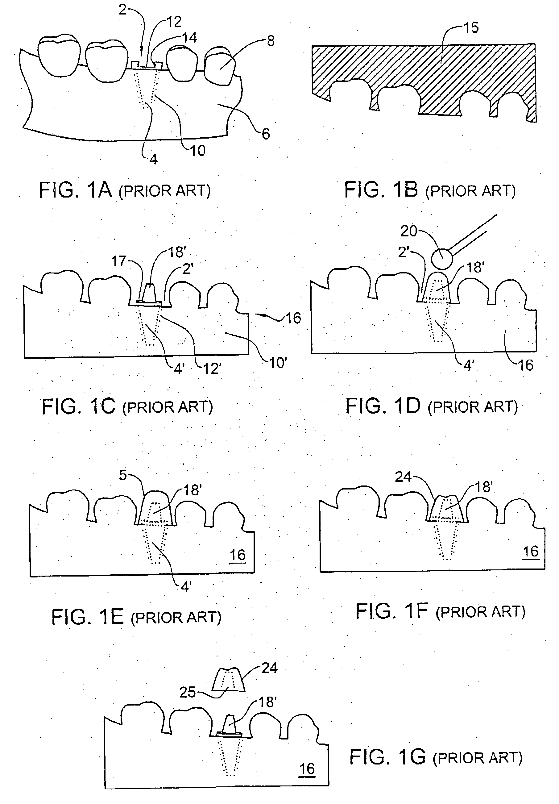 Method and accessory for preparing a dental crown or bridge