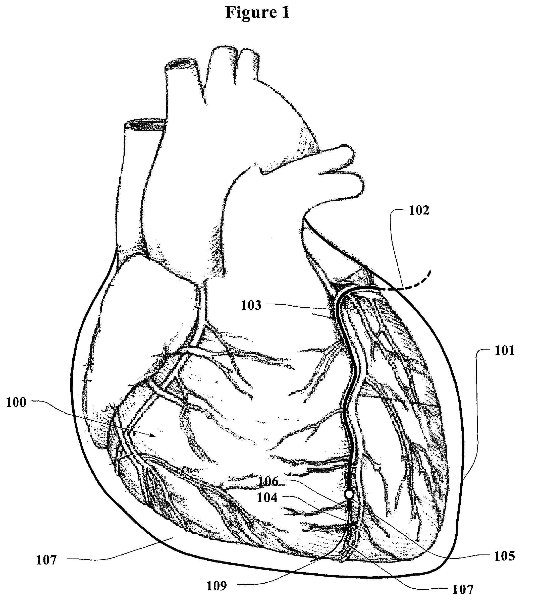 Method and device for accessing a pericardial space