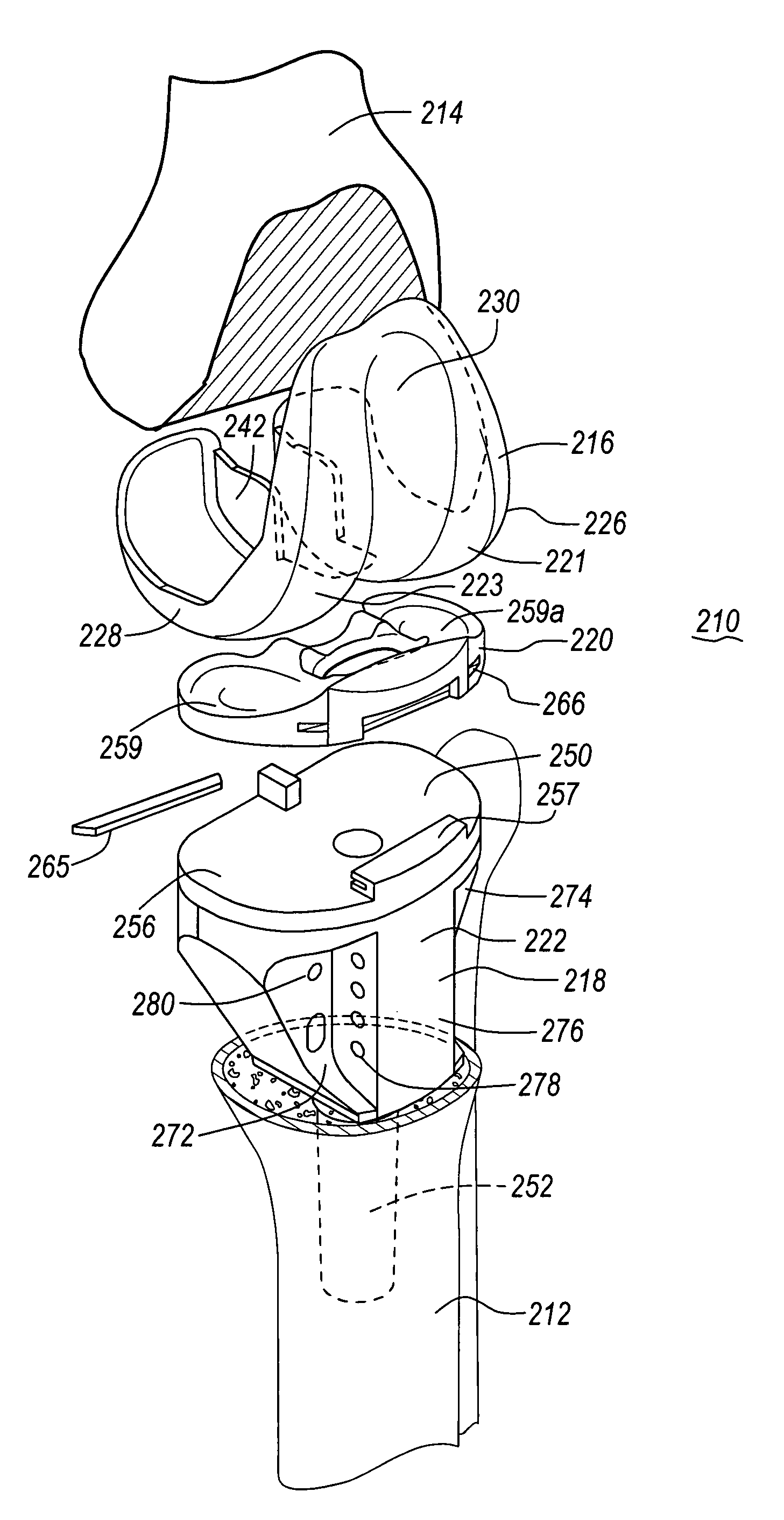 Prosthesis having a modular soft tissue fixation mechanism