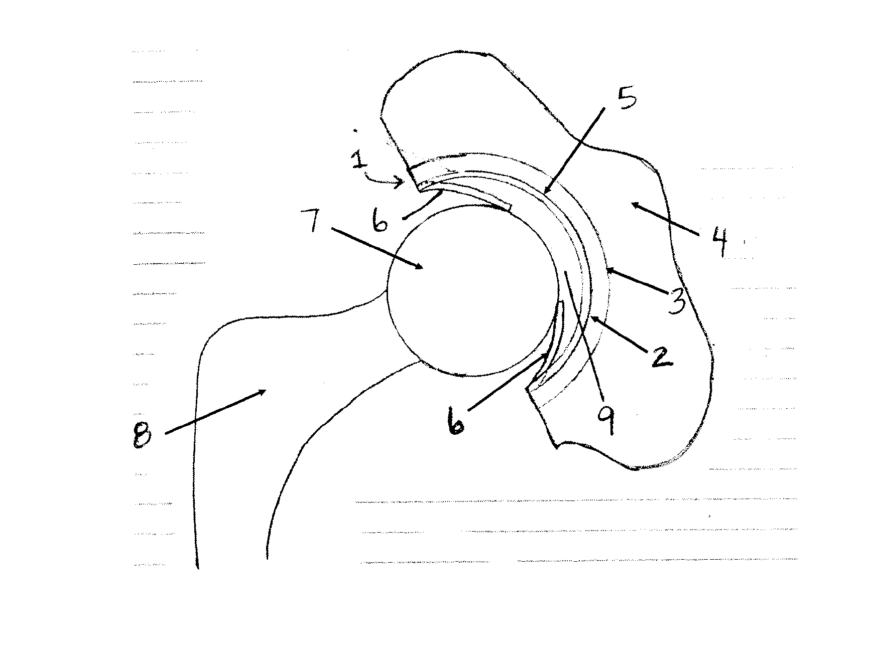 An artificial hip joint replacement system