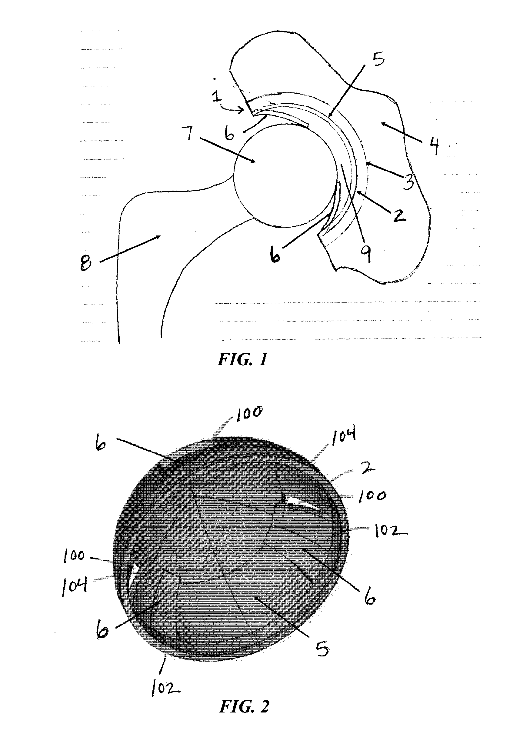 An artificial hip joint replacement system