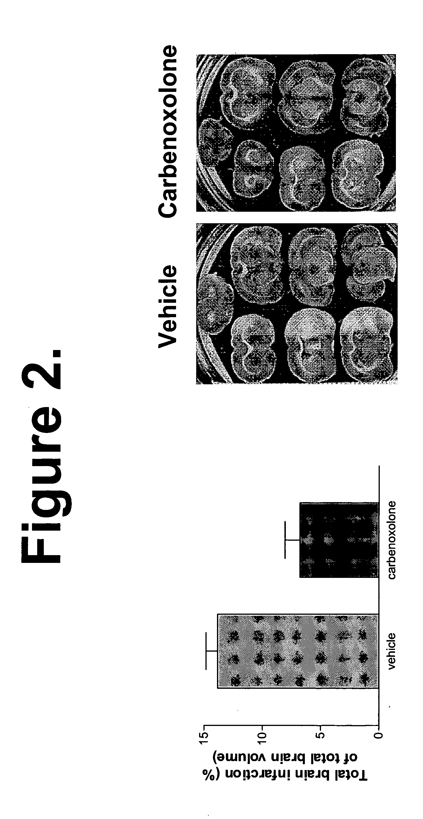 Treatment of neurologic disorders with inhibitors of 11beta-HSD1