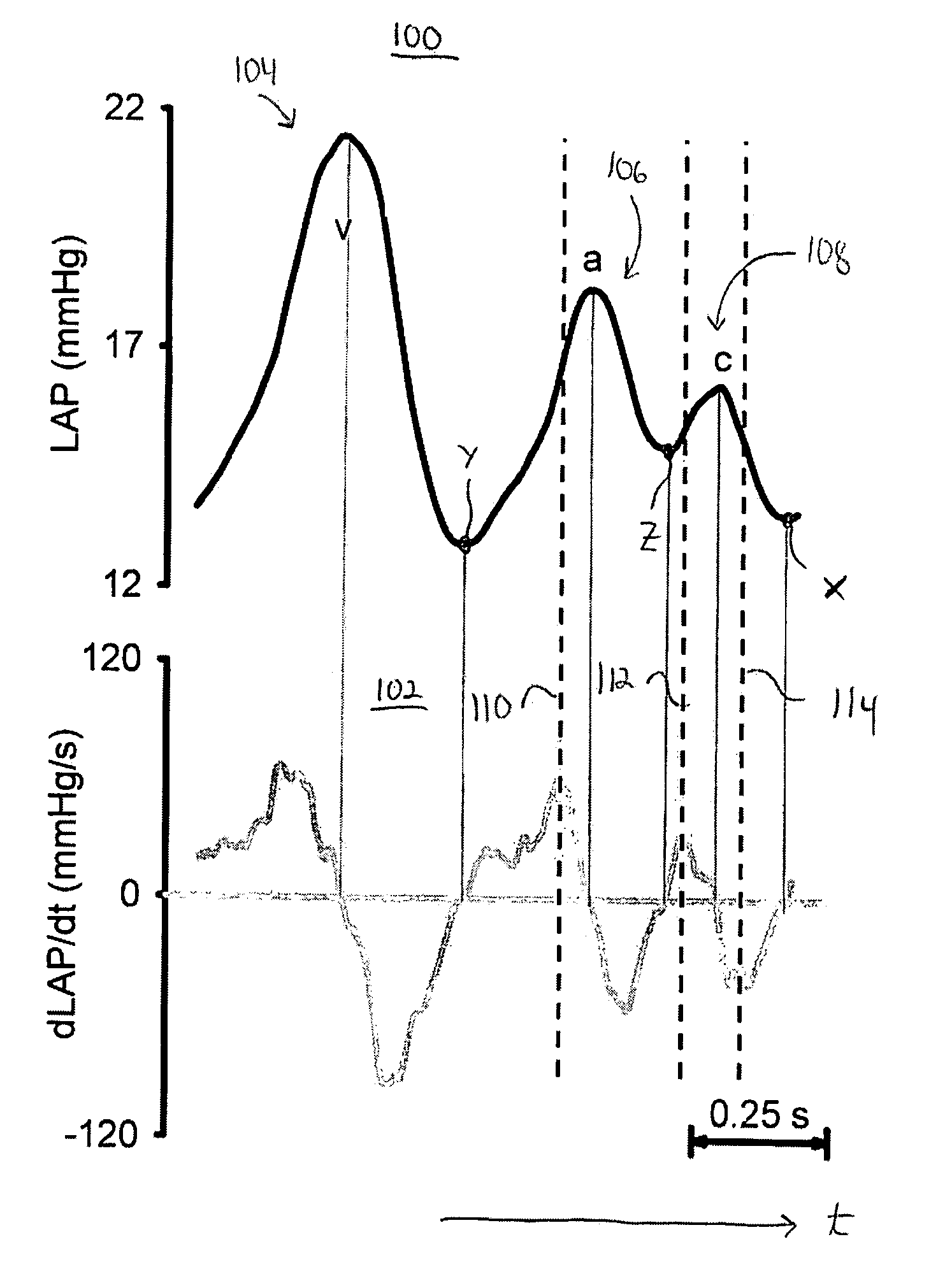 System and method for controlling implantable medical device parameters in response to atrial pressure attributes