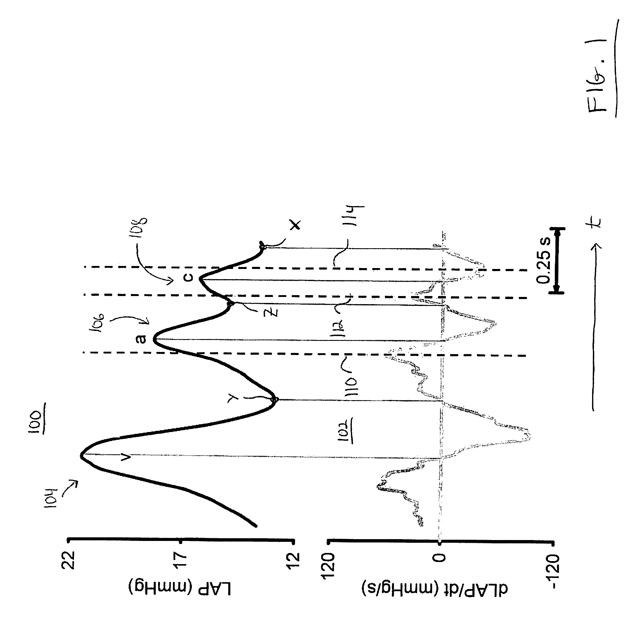 System and method for controlling implantable medical device parameters in response to atrial pressure attributes