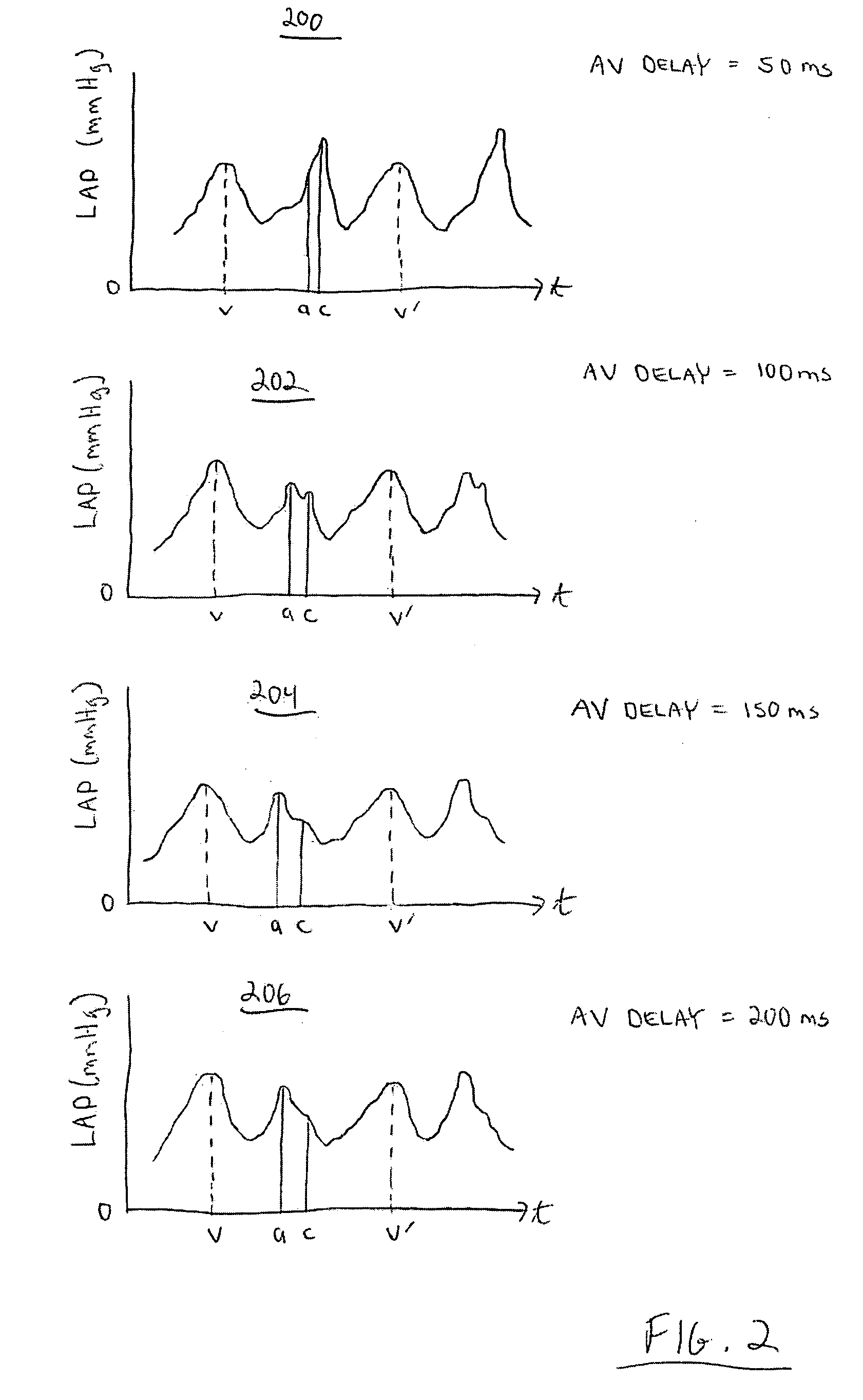 System and method for controlling implantable medical device parameters in response to atrial pressure attributes