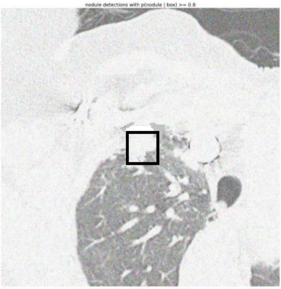 Medical image pulmonary nodule detection based on depth learning