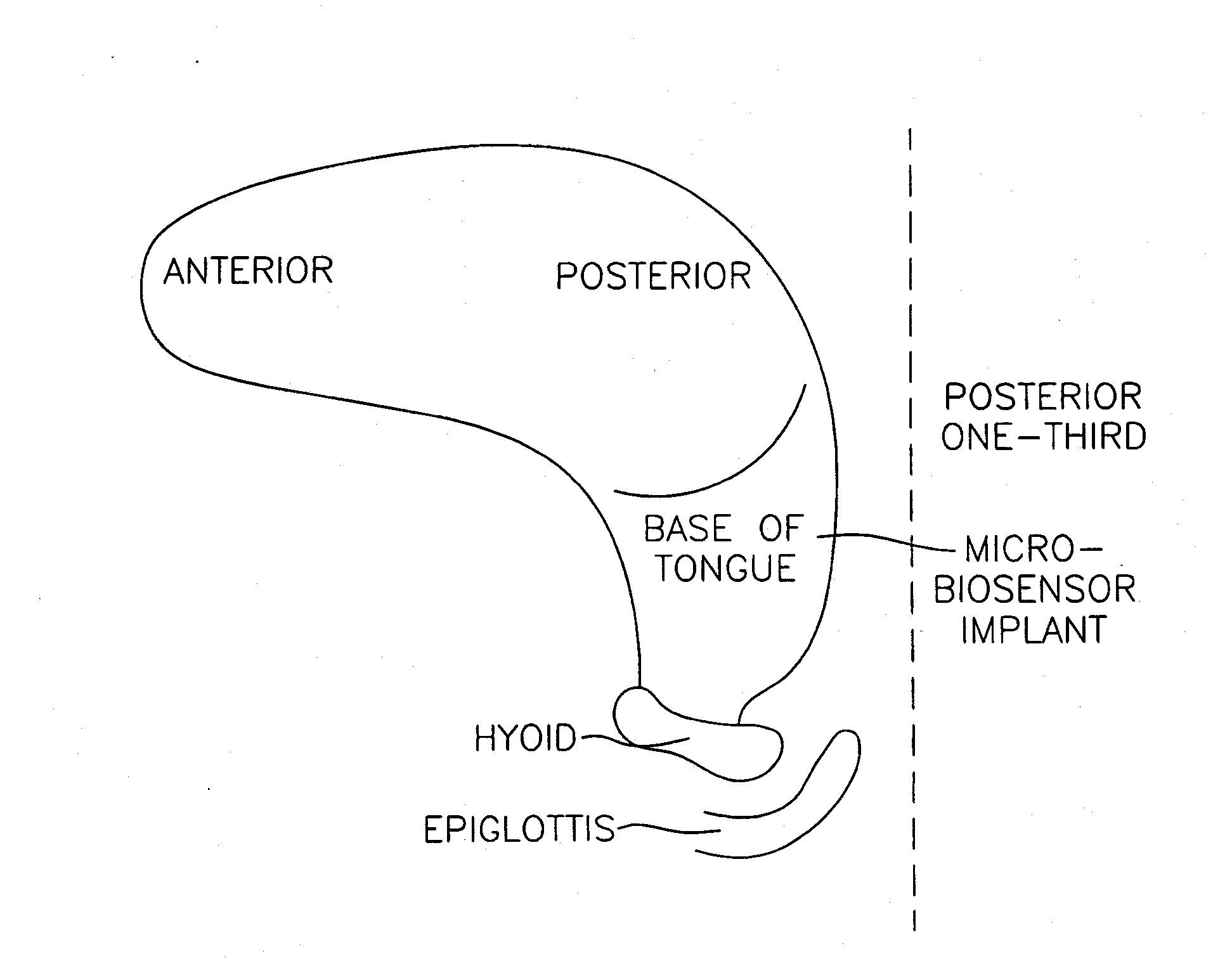 Method and apparatus for preventing obstructive sleep apnea