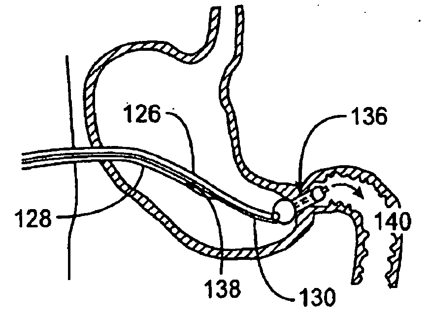 Pyloric valve obstructing devices and methods