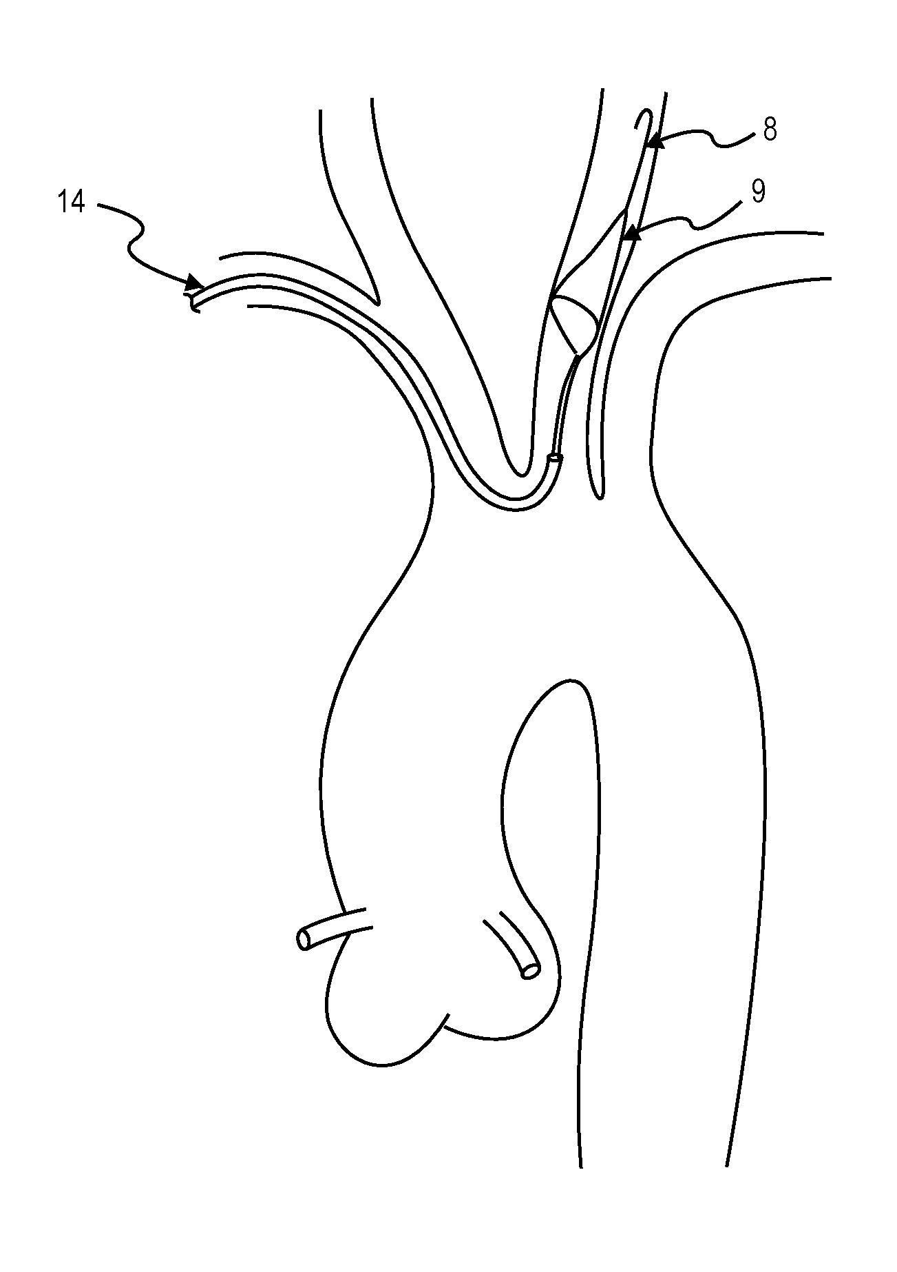 Intravascular blood filter