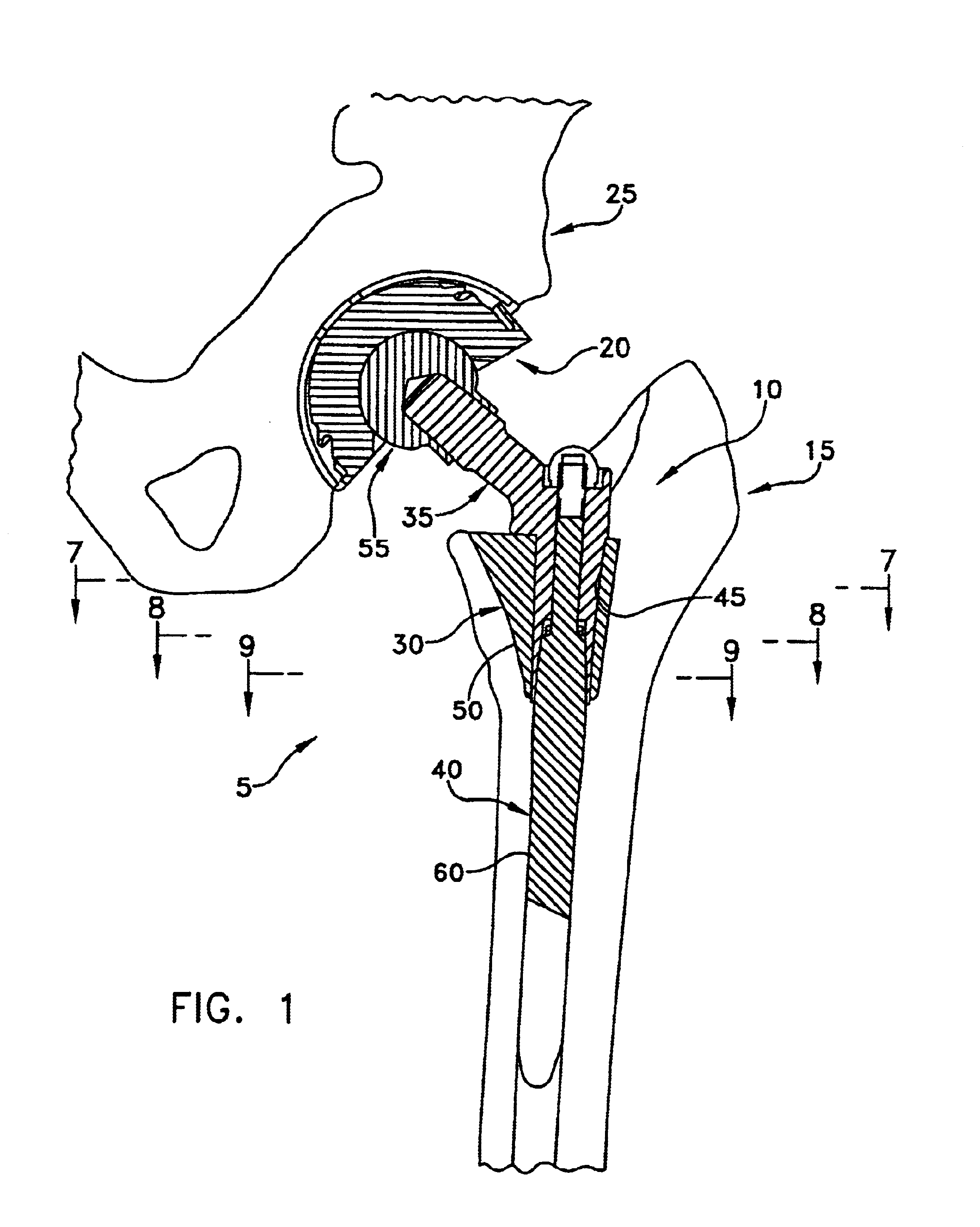 Modular prosthetic component with improved body shape