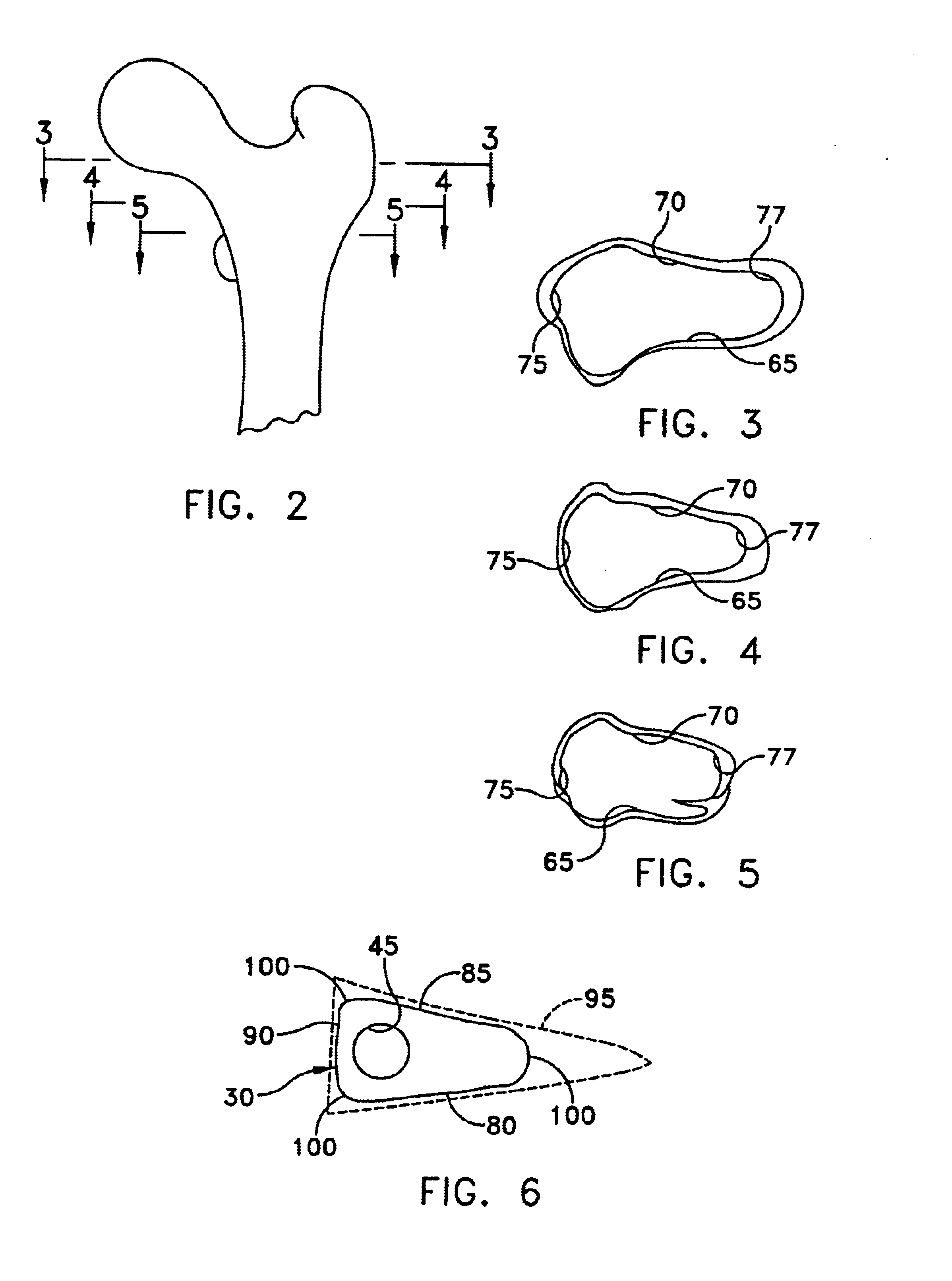 Modular prosthetic component with improved body shape