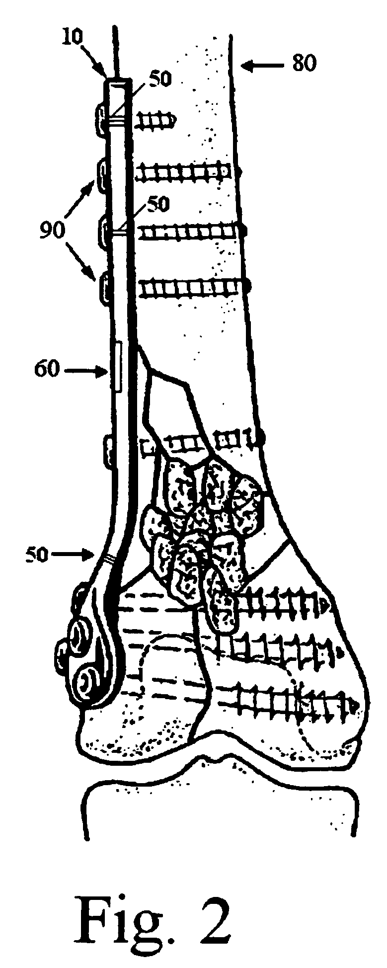 Orthopaedic implant with sensors