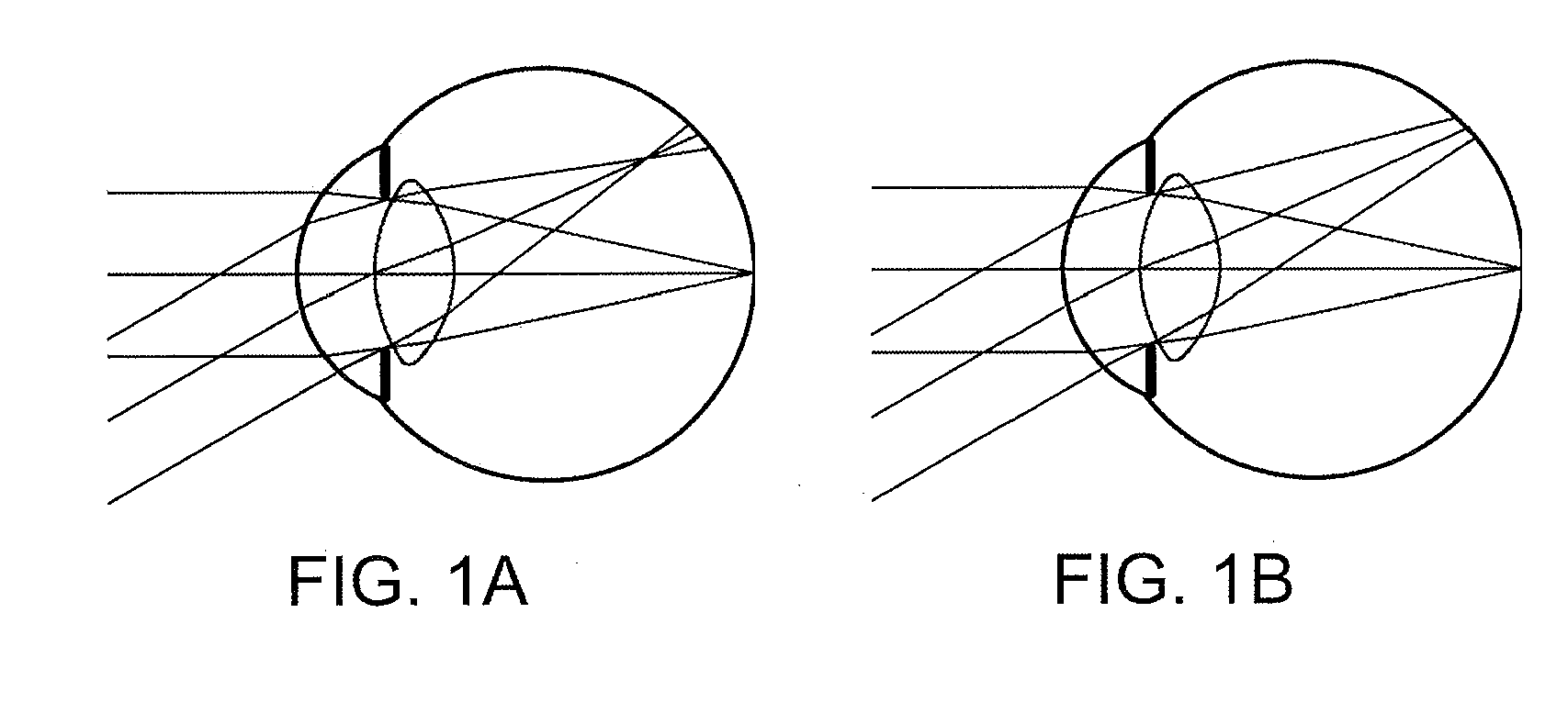 Device for asymmetrical refractive optical correction in the peripheral retina for controlling the progression of myopia