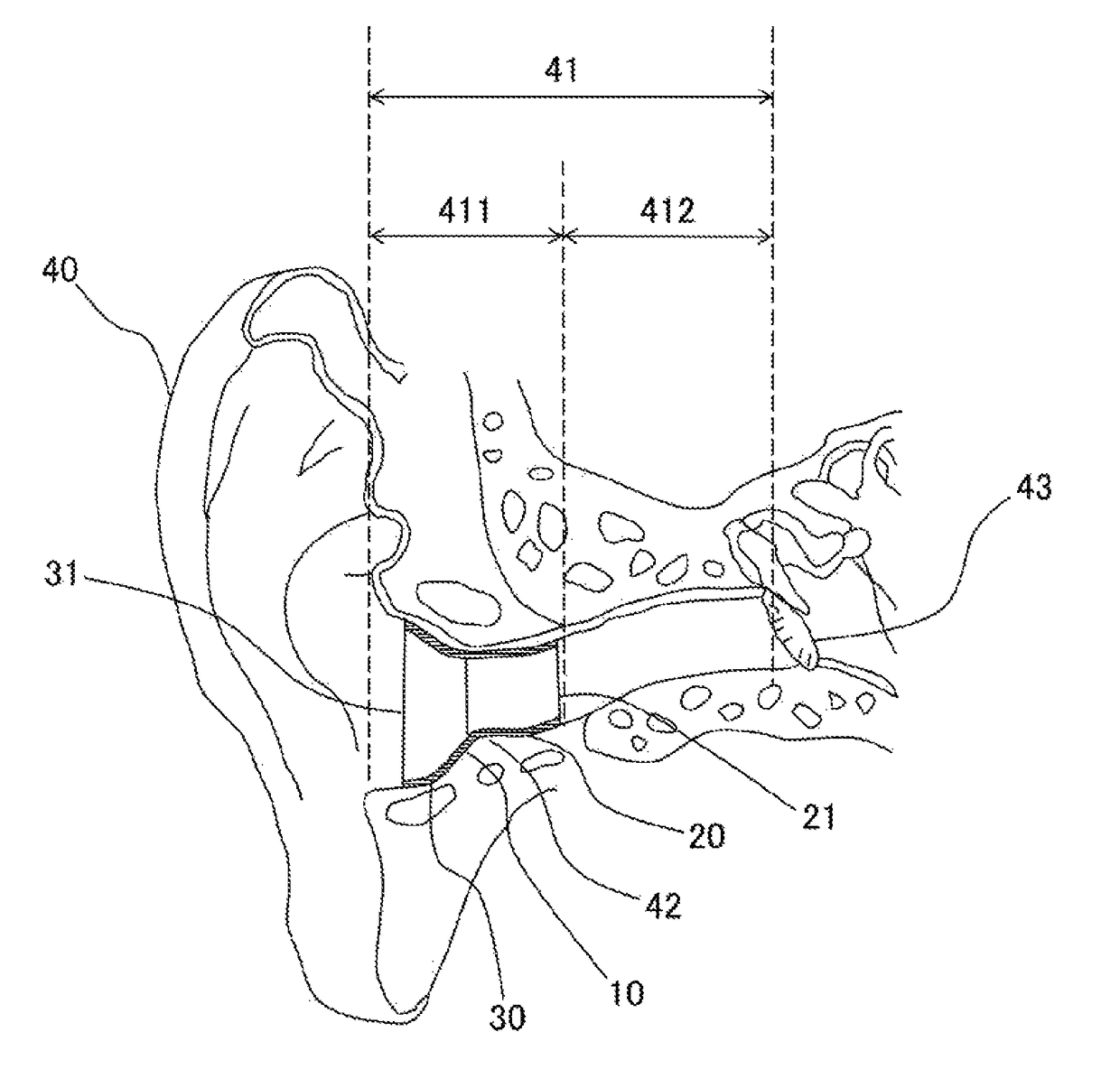 Simplified hearing aid