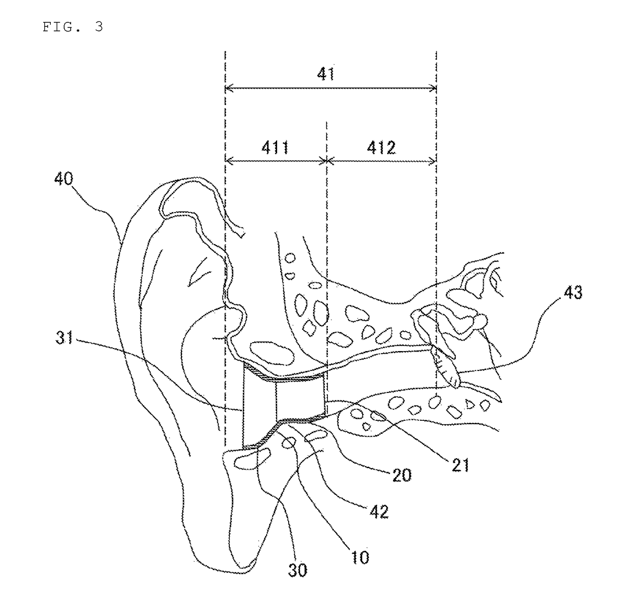 Simplified hearing aid