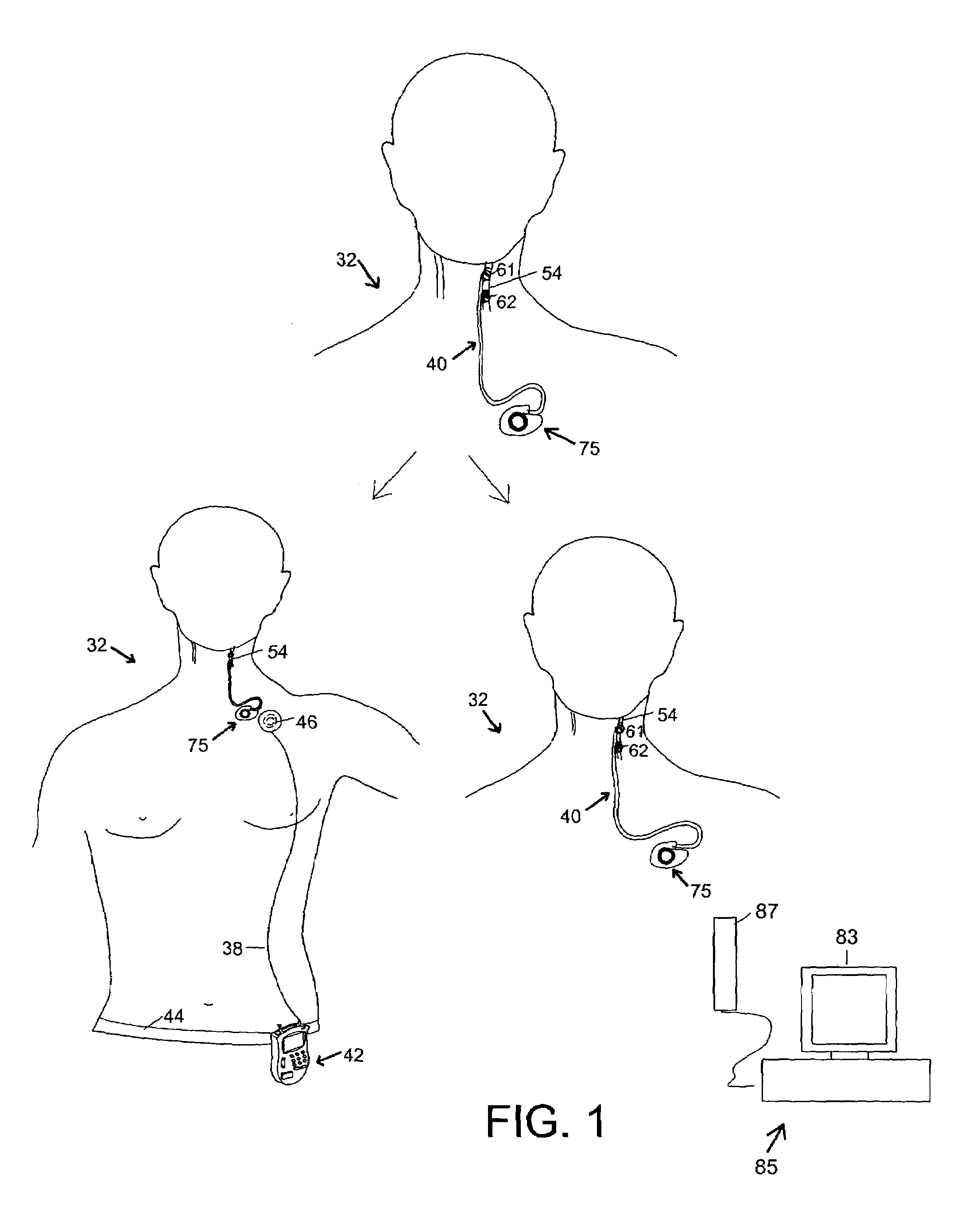 Method and system for providing pulsed electrical stimulation to a craniel nerve of a patient to provide therapy for neurological and neuropsychiatric disorders