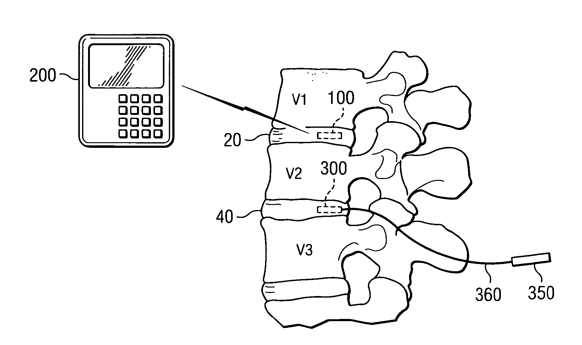 Sensor and method for spinal monitoring