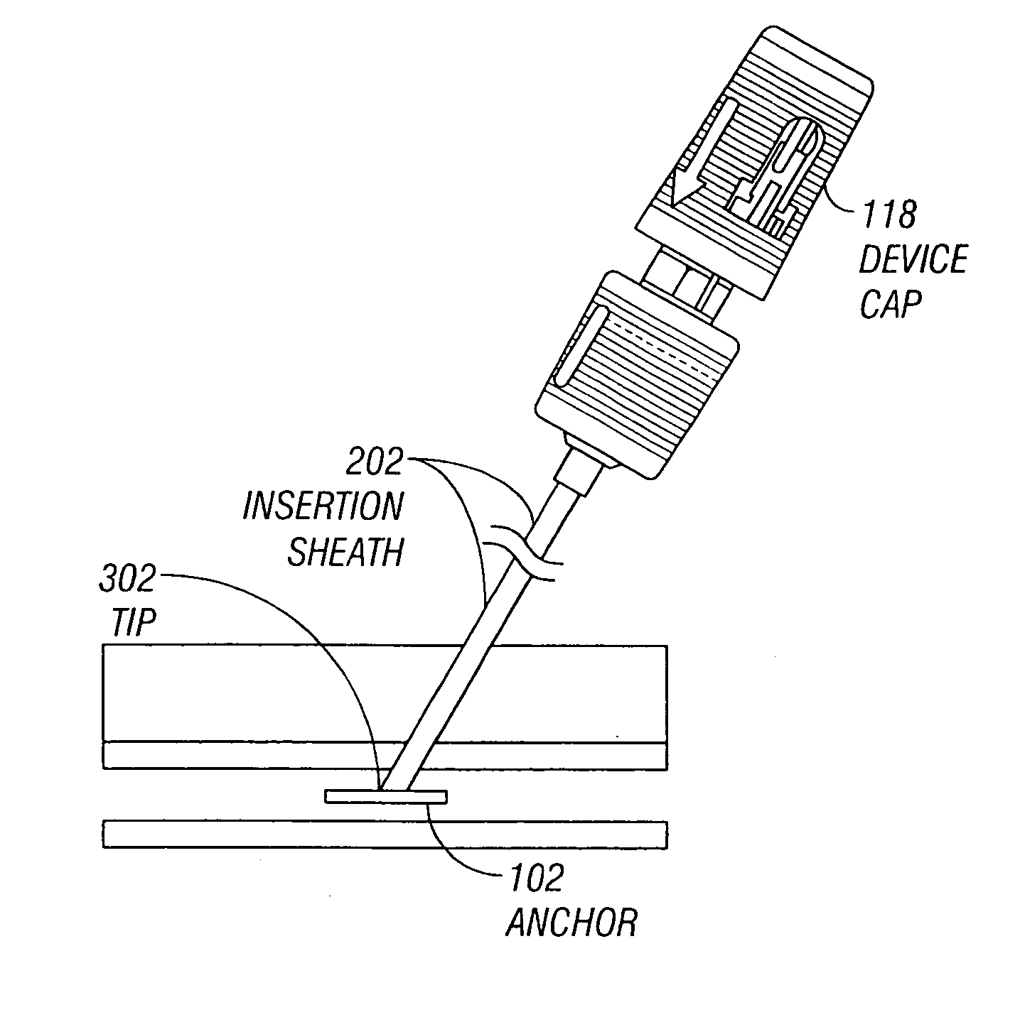 Automatic suture locking device