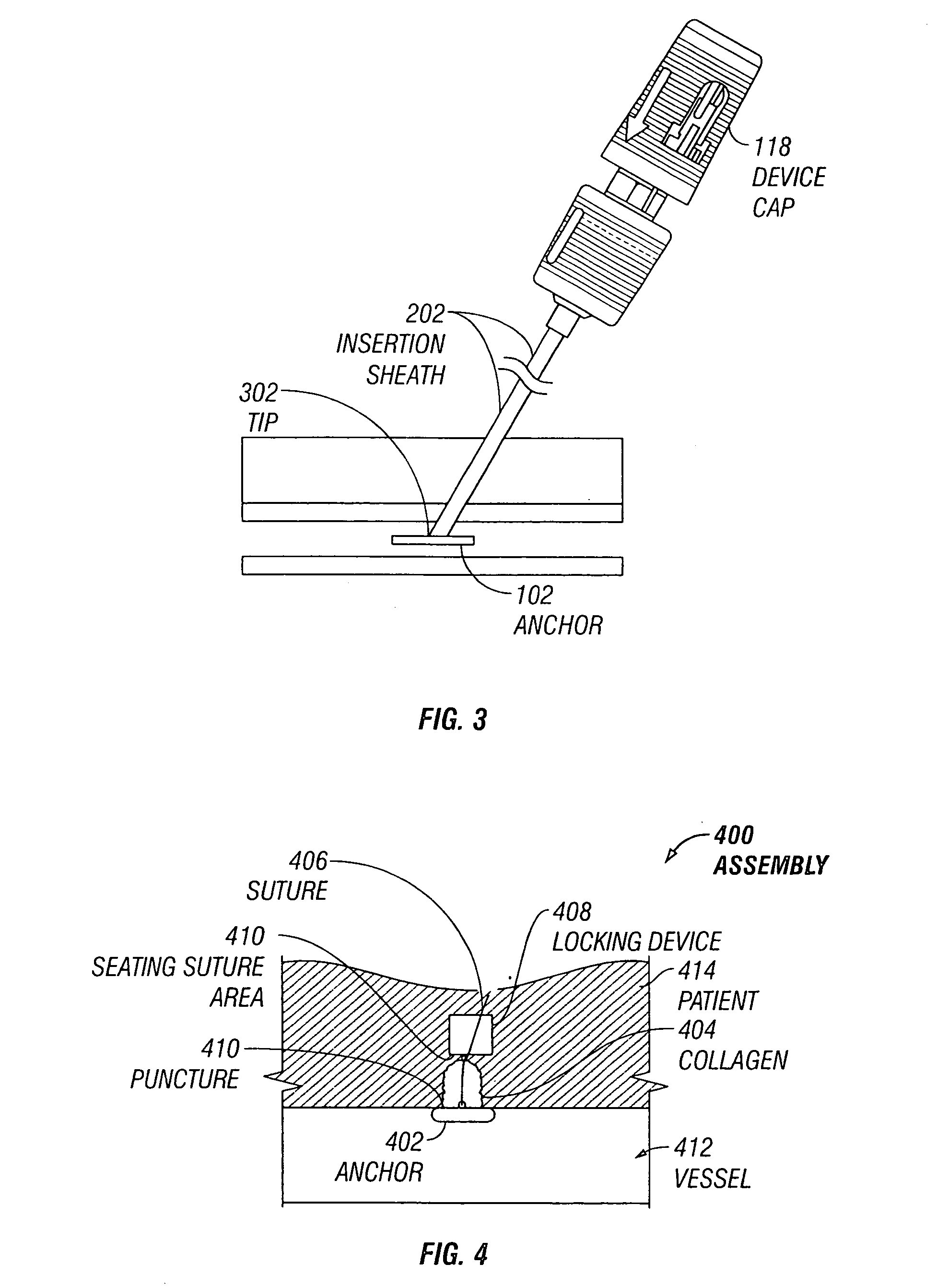 Automatic suture locking device