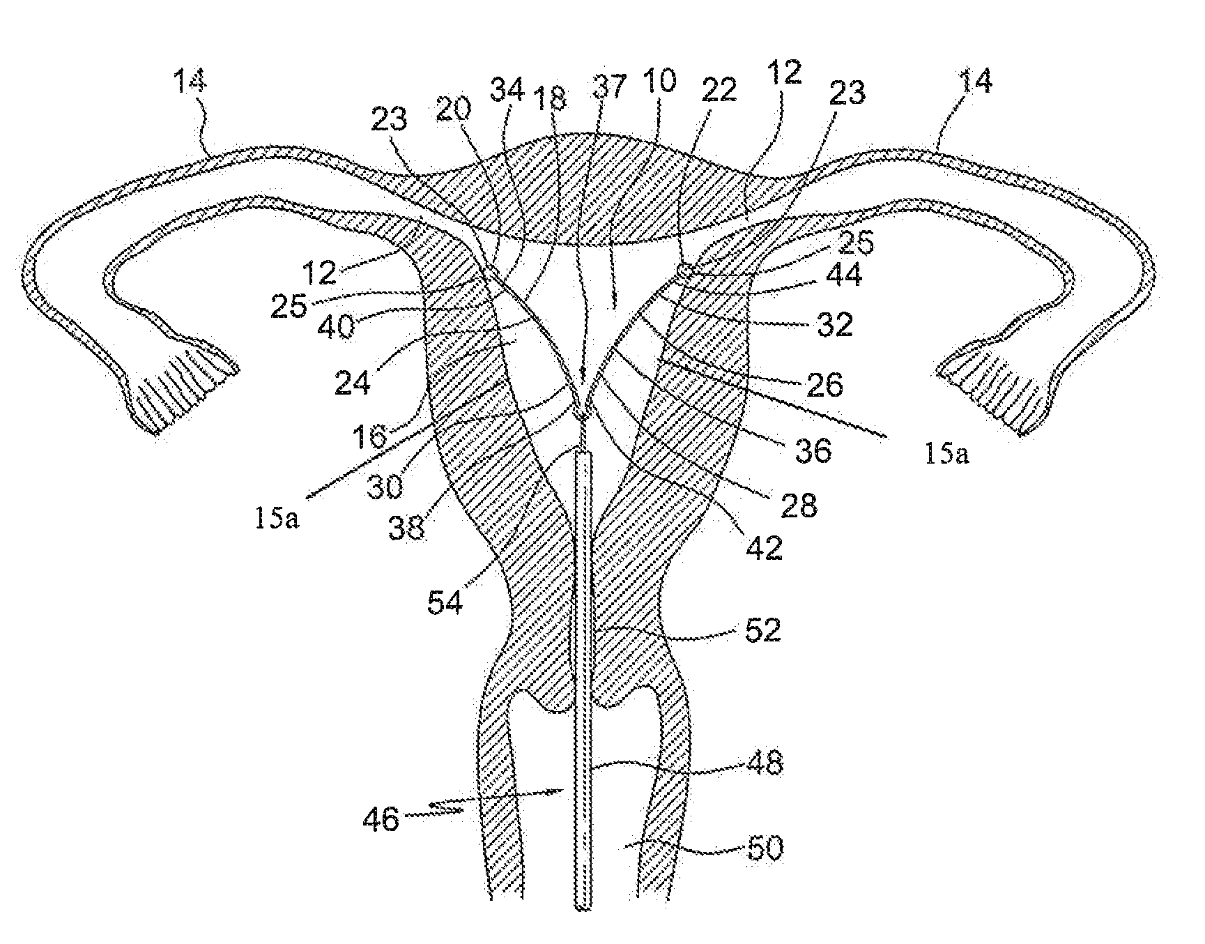 Intrauterine device