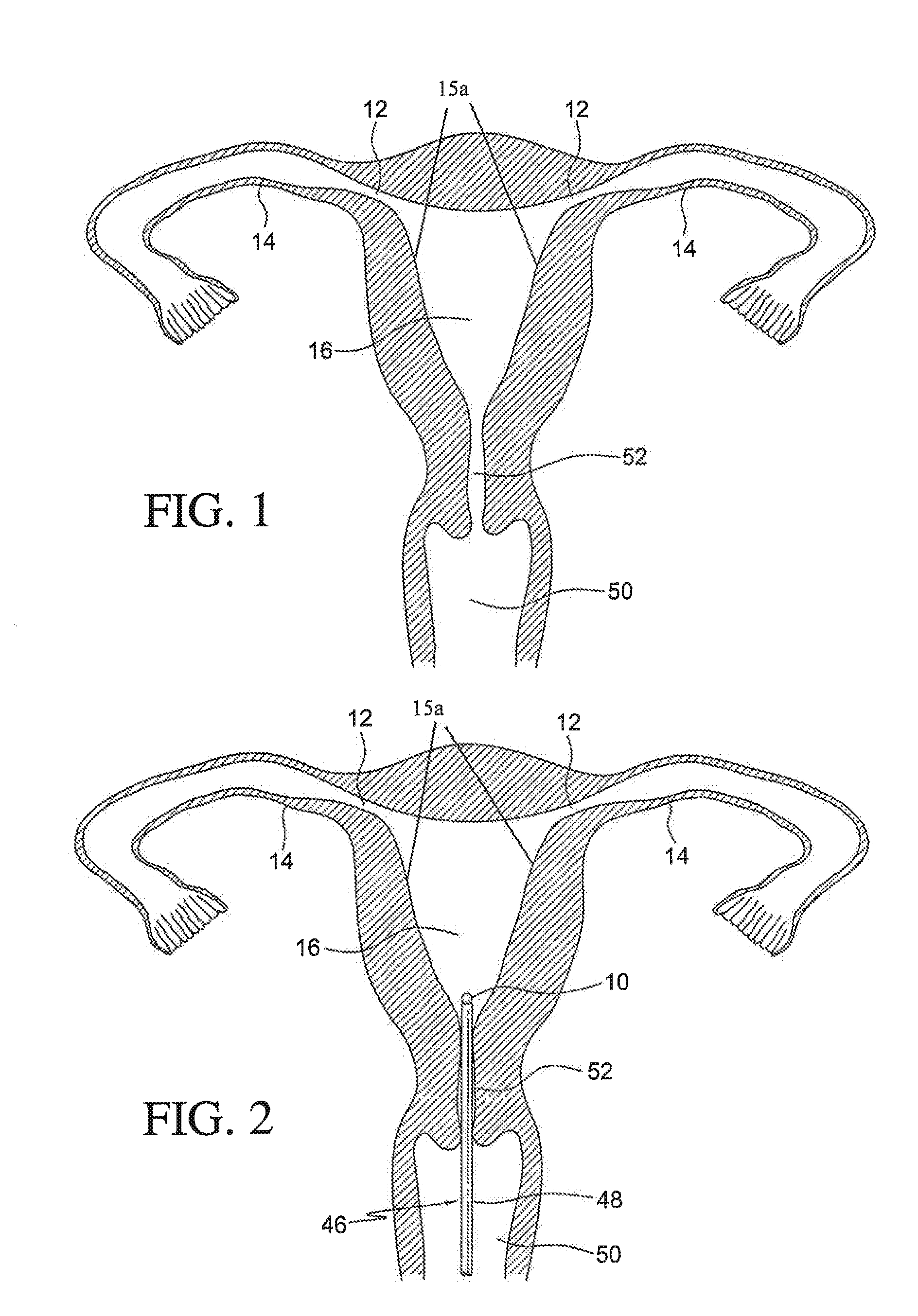 Intrauterine device