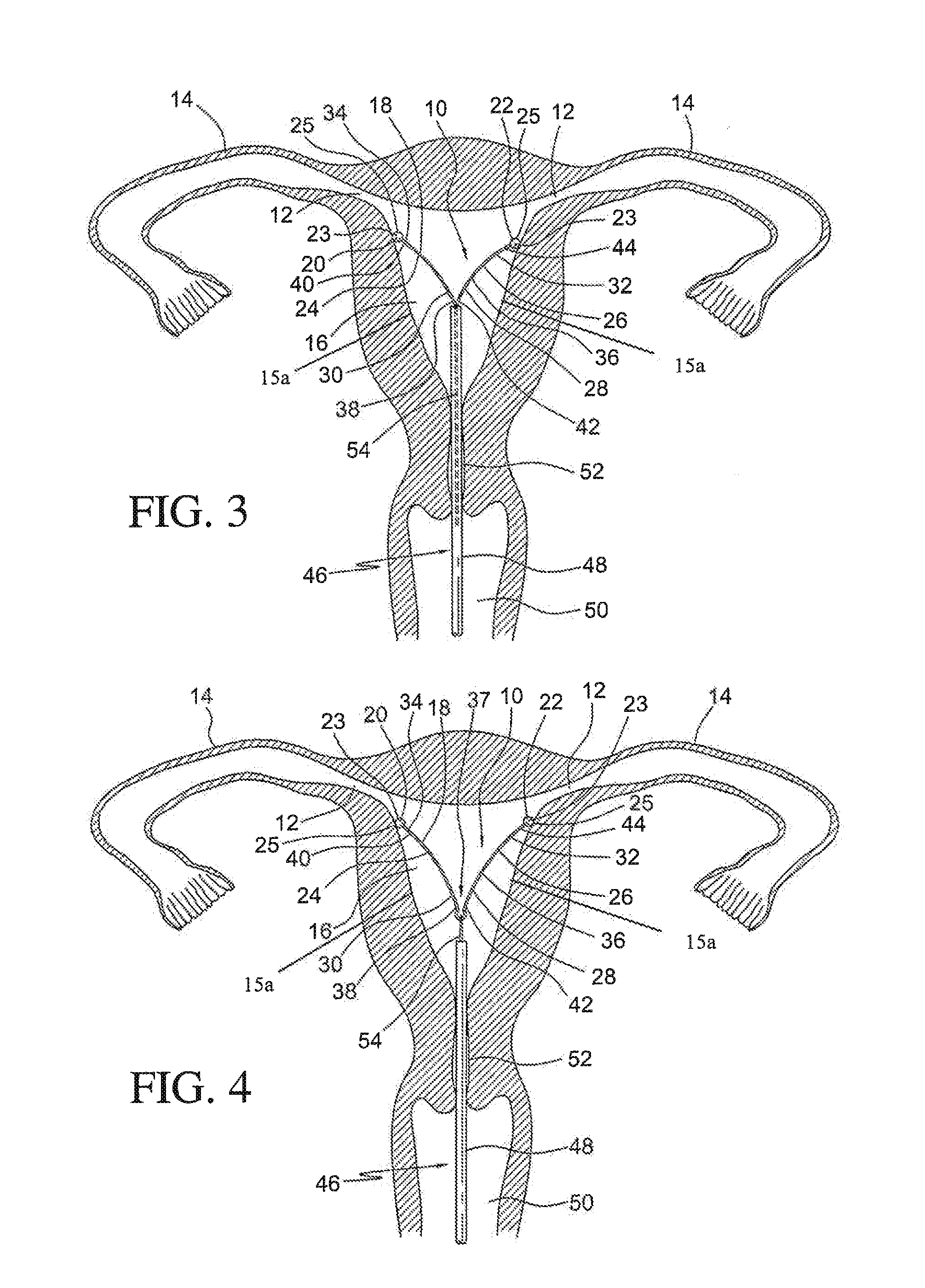 Intrauterine device