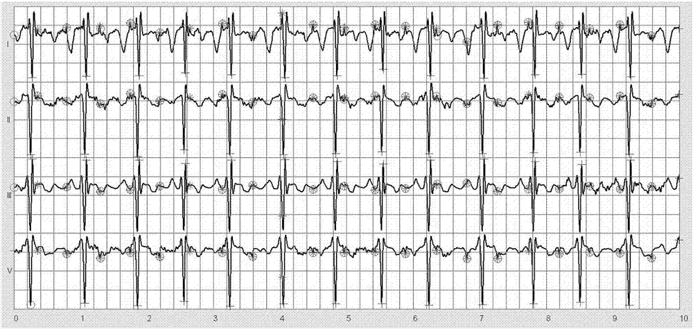 Intelligent terminal for extracting the heart rate of fetus