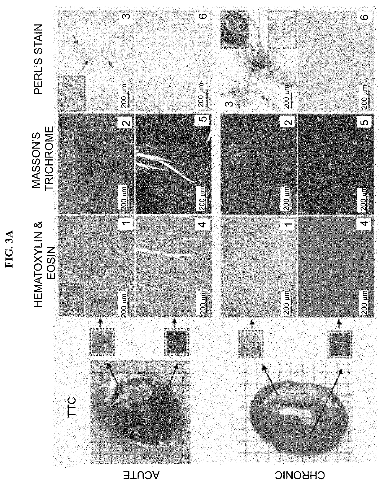 Assessment of iron deposition post myocardial infarction as a marker of myocardial hemorrhage