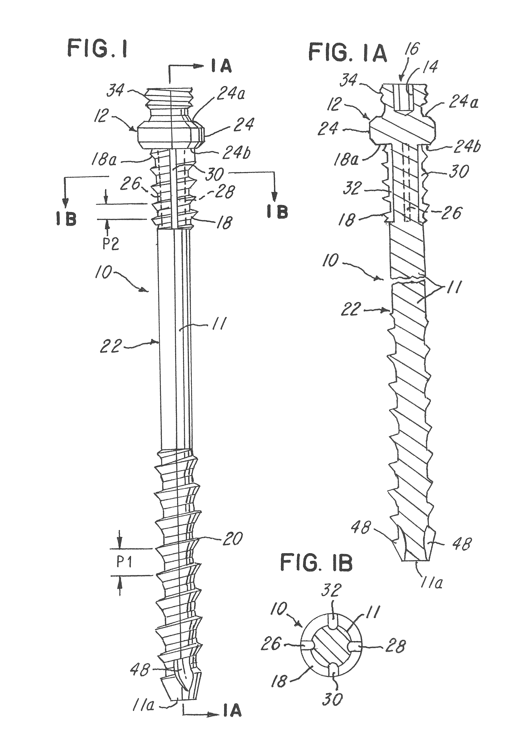 Minimally invasive spinal facet compression screw and system for bone joint fusion and fixation