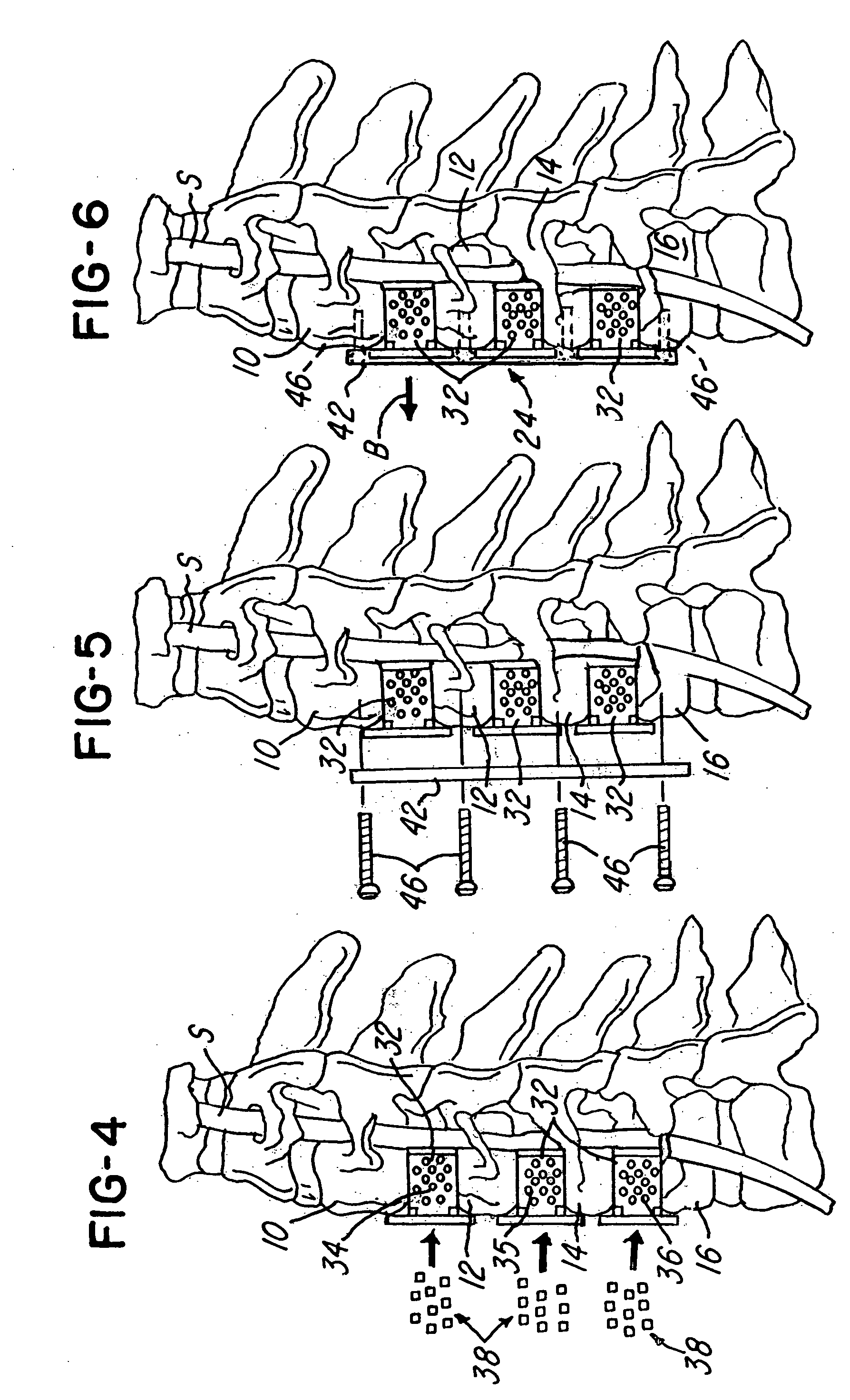 Spinal fusion system and method for fusing spinal bones