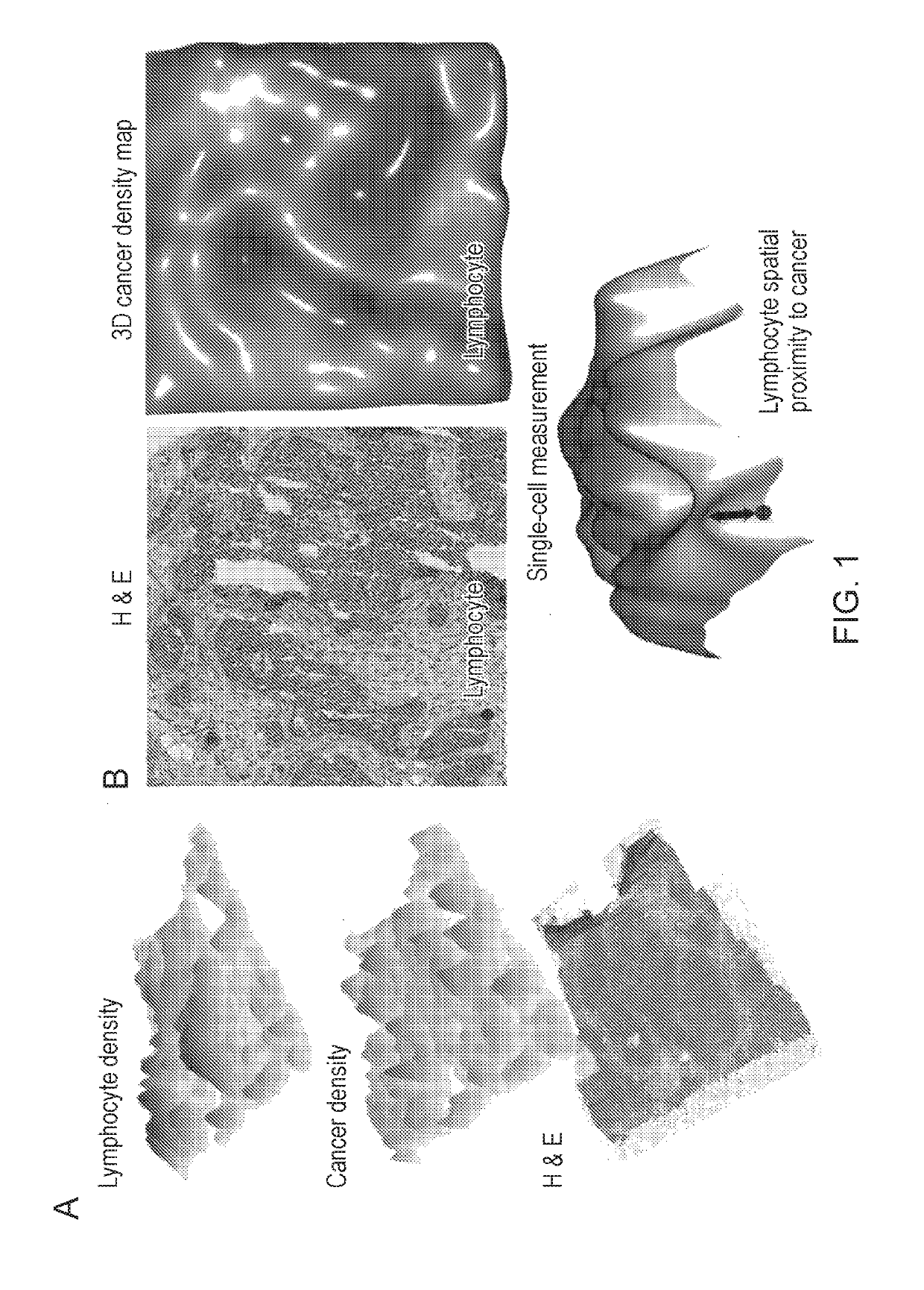 Scoring of tumor infiltration by lymphocytes