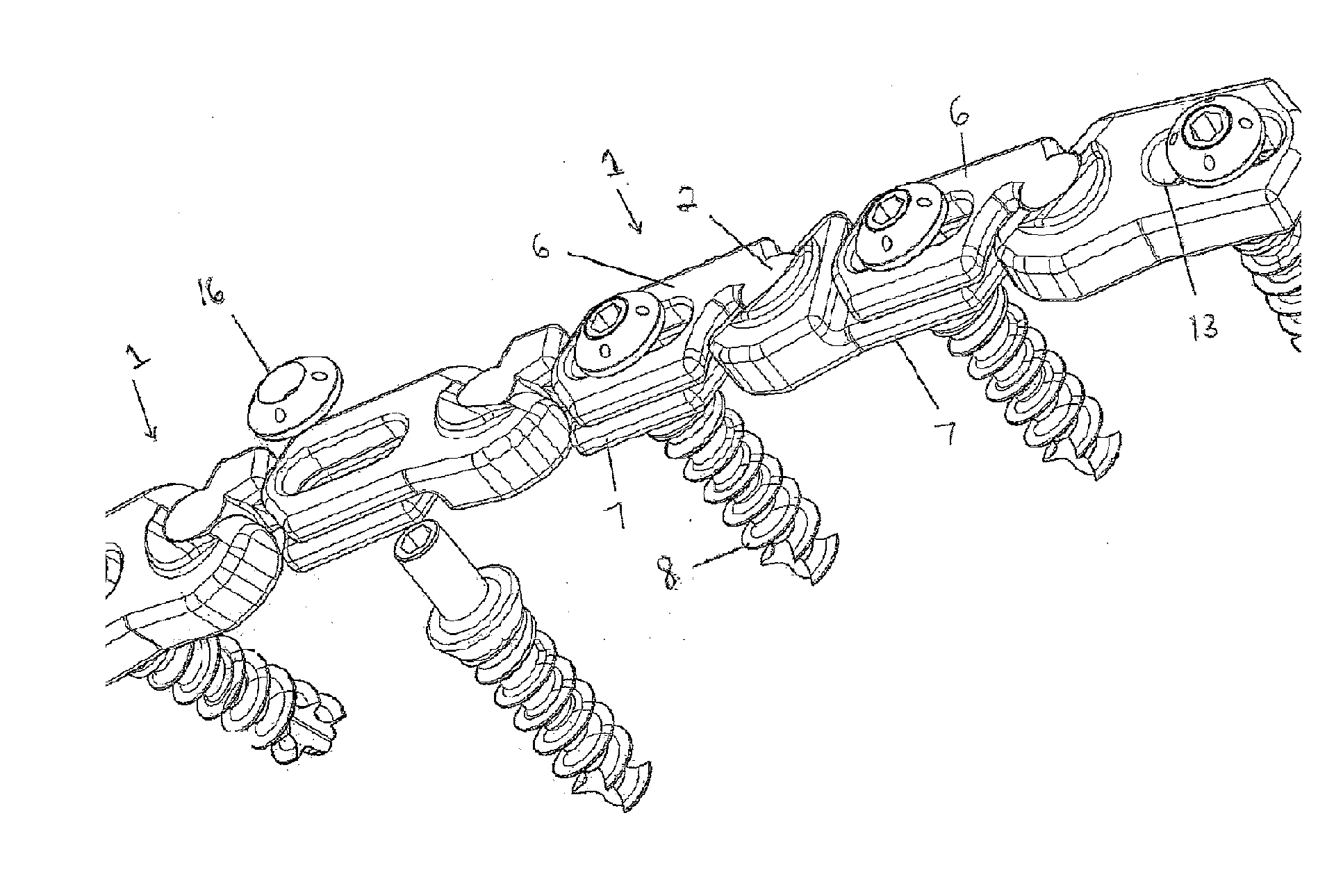 Implantable apparatus for modulation of skeletal growth