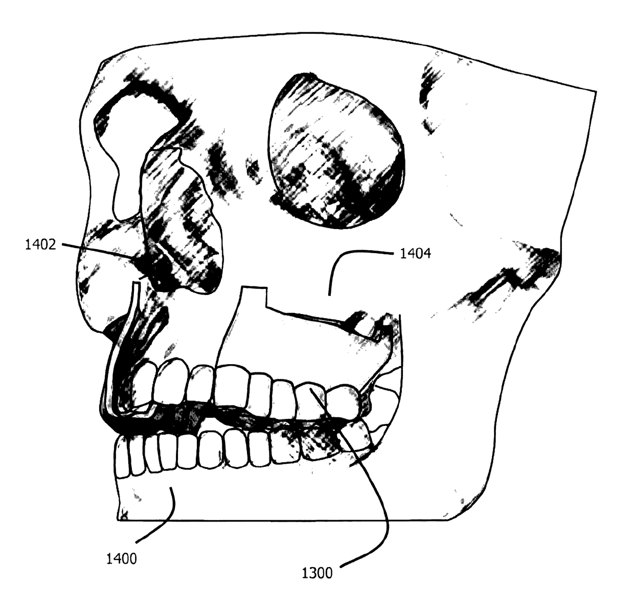 Computer-implemented technique for defining a bone cut