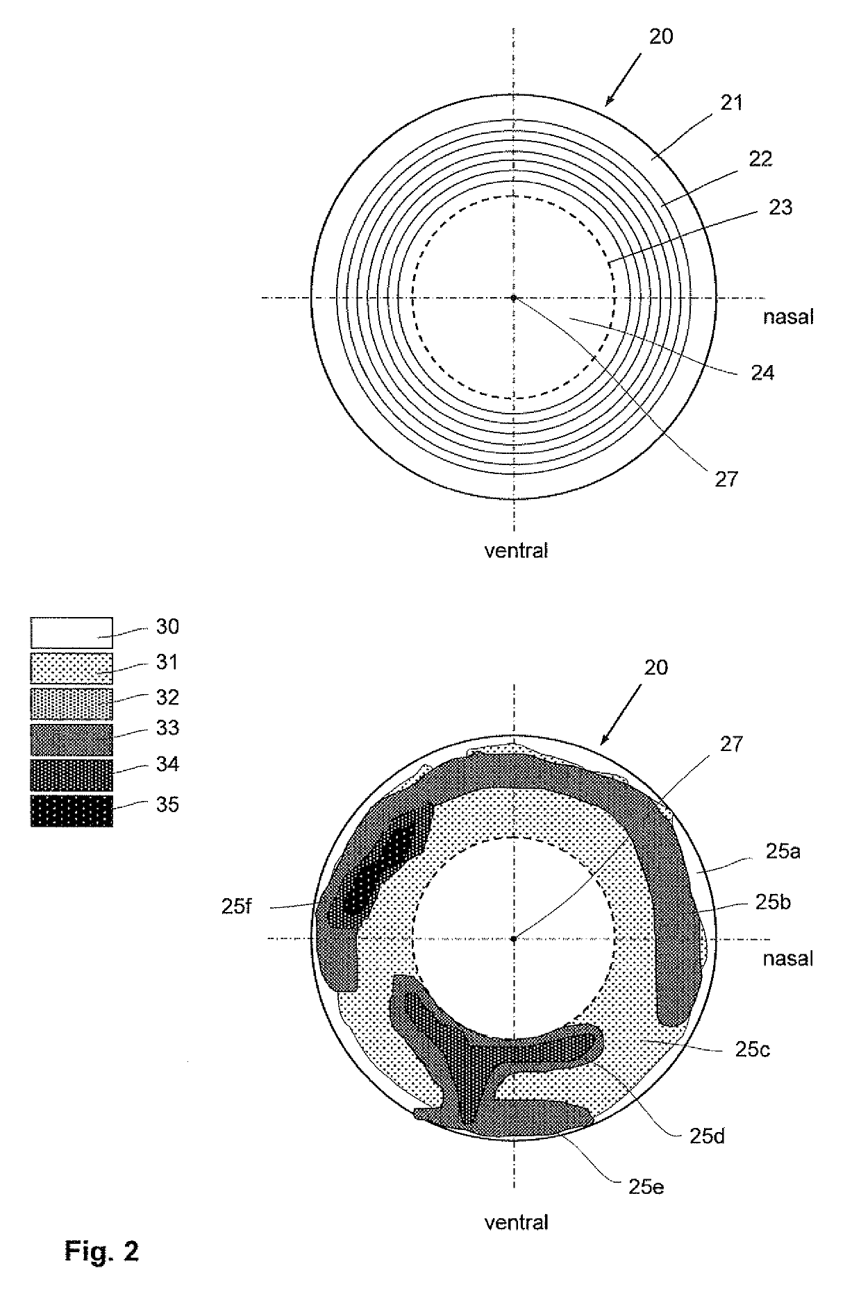 Laser therapy system for noninvasive correction of the refractive system of the eye