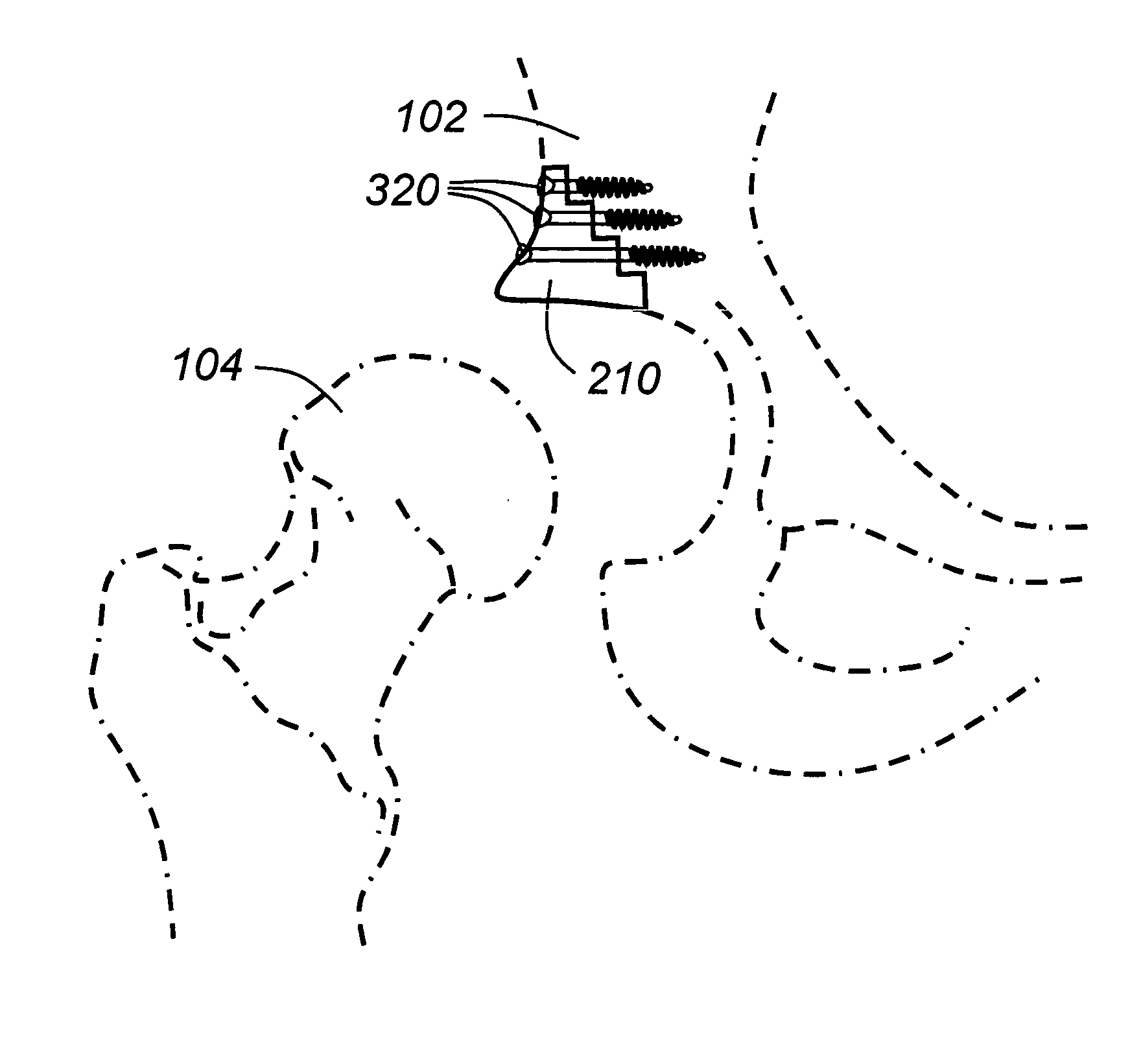 Geometric replacements for defective bone