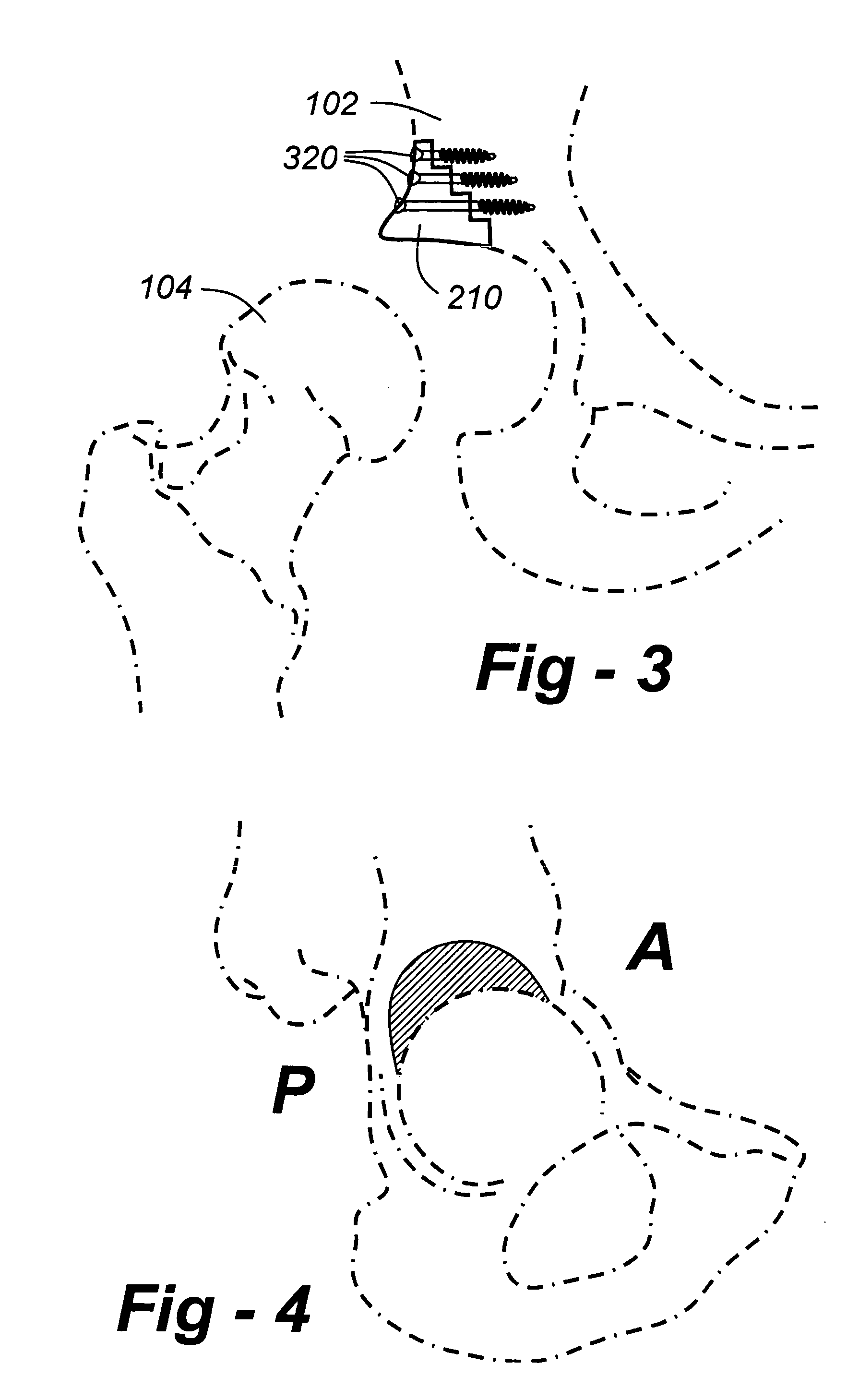 Geometric replacements for defective bone