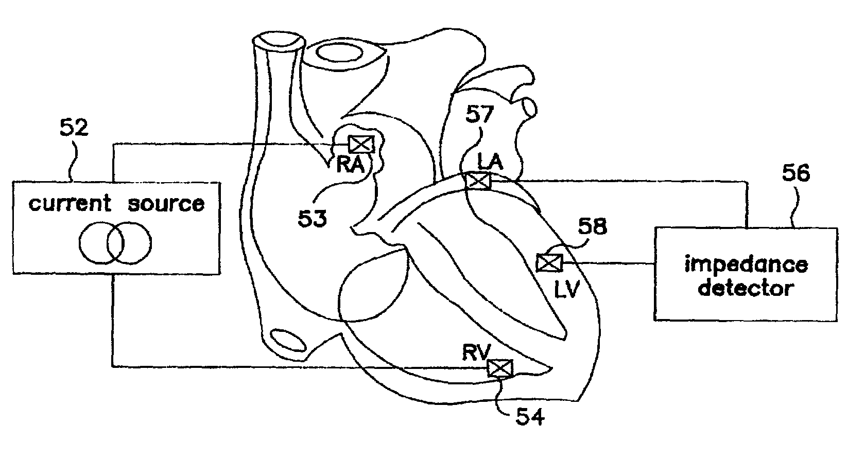 Algorithm for the automatic determination of optimal AV and VV intervals