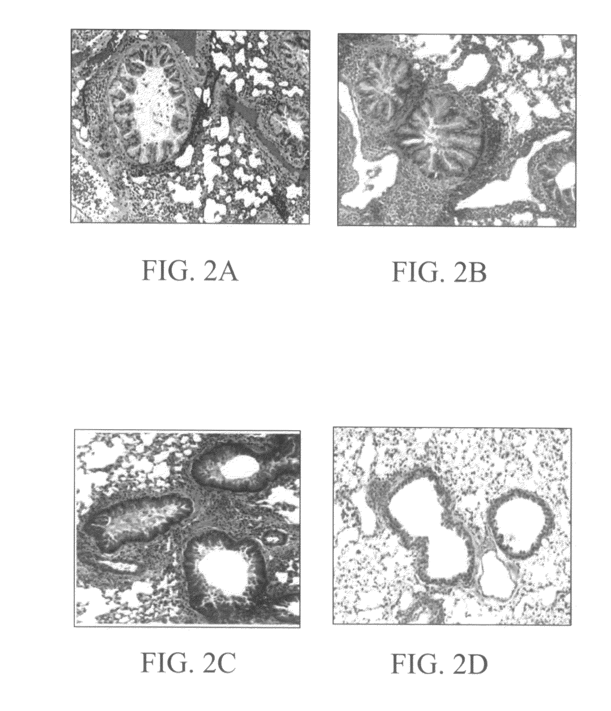 Methods and compositions for reducing activity of the atrial natriuretic peptide receptor and for treatment of diseases