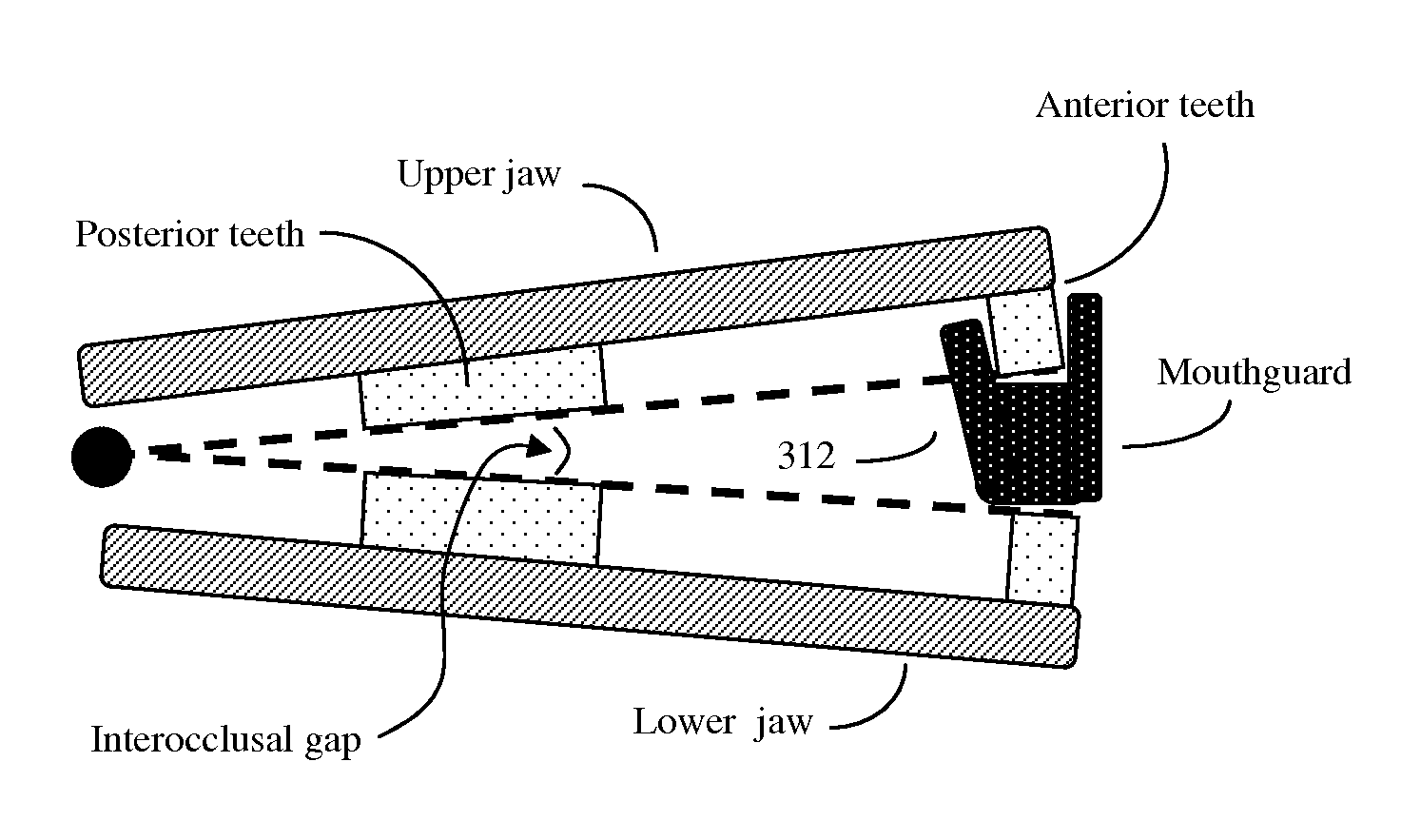 Swing bite mini mouthpiece