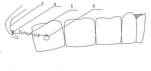 Molar distantly-moving device