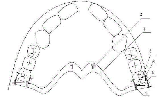 Molar distantly-moving device