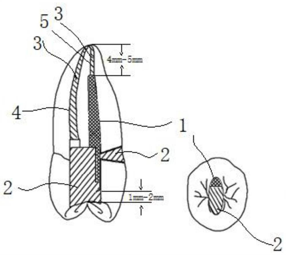 A kind of fibrous tape prosthesis of maxillary premolar penetrating wedge-shaped defect and its preparation method