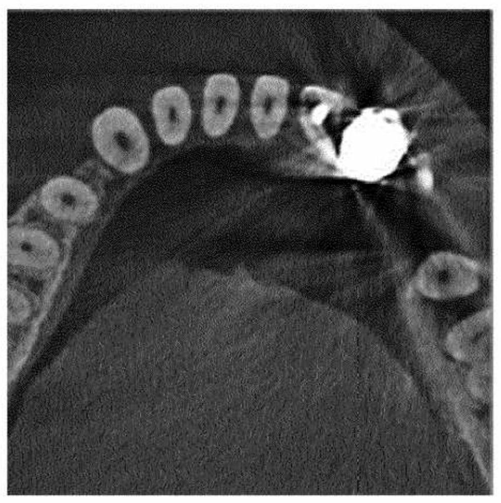 Method of metal artefact reduction in x-ray dental volume tomography