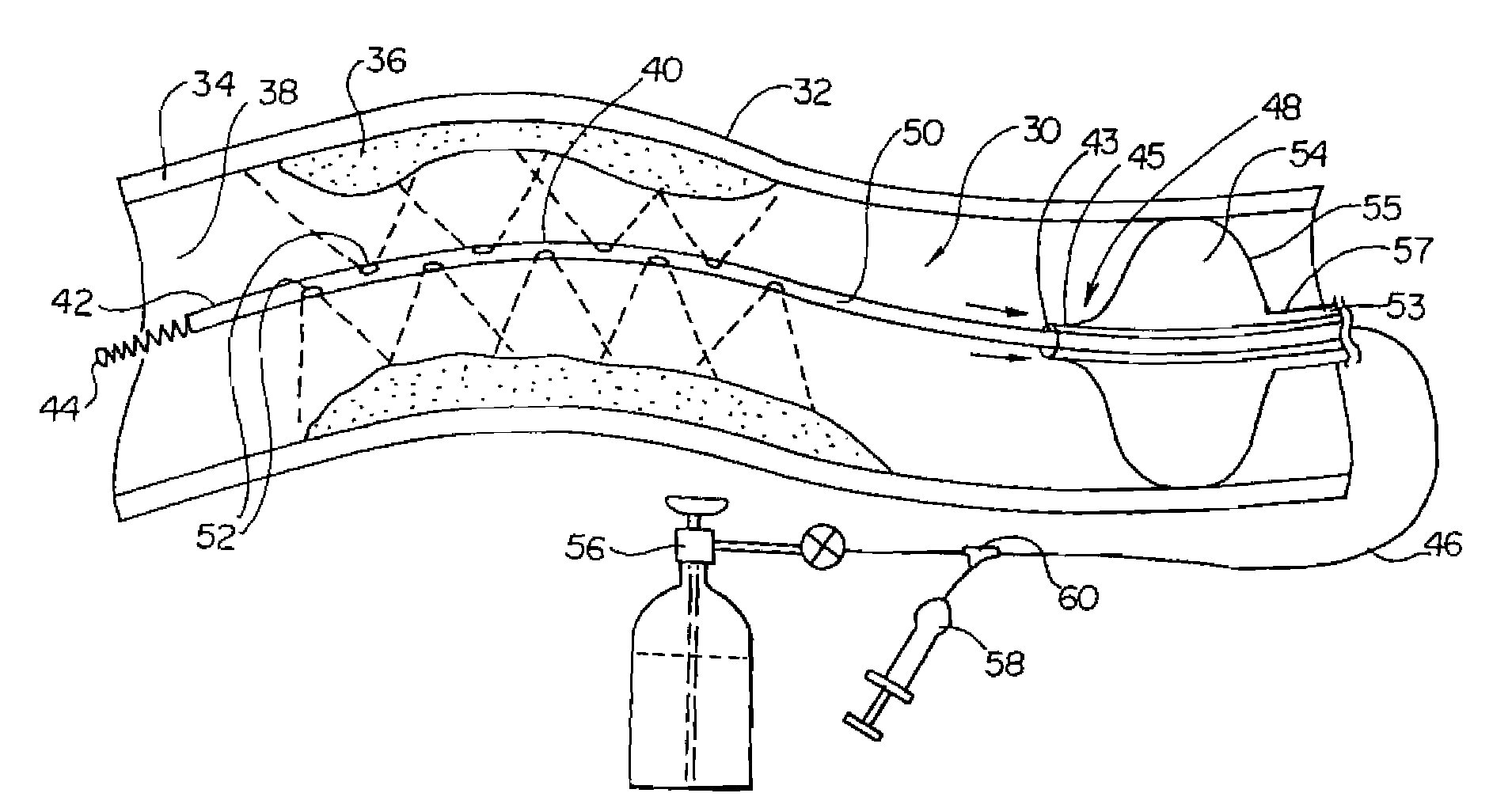 Cryotreatment device and method