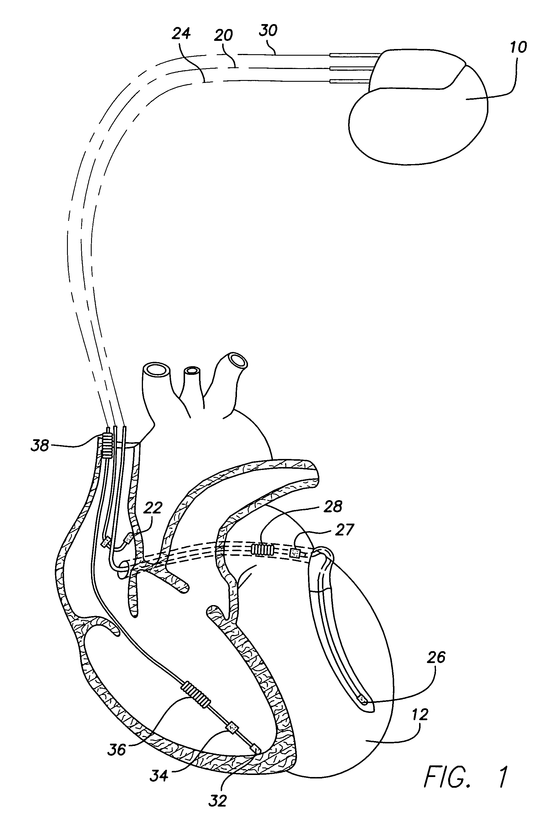 Cardiac stimulation device with selective atrial pacing on premature ventricular complex detection and method