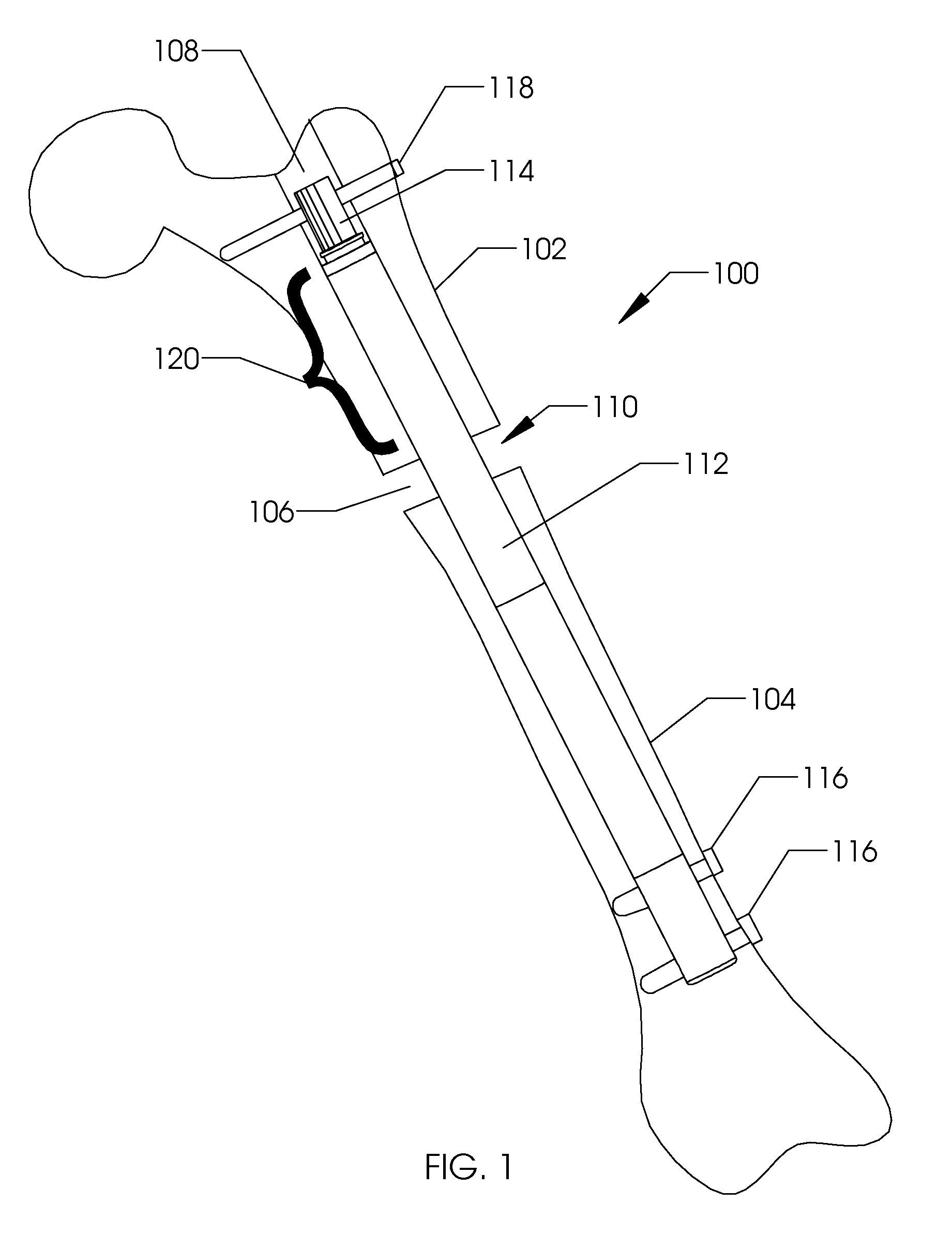 Bone growth device and method