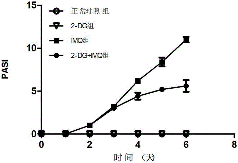 Application of 2-deoxy-D-glucose and pharmaceutically acceptable salt thereof in preparation of psoriasis treatment drug